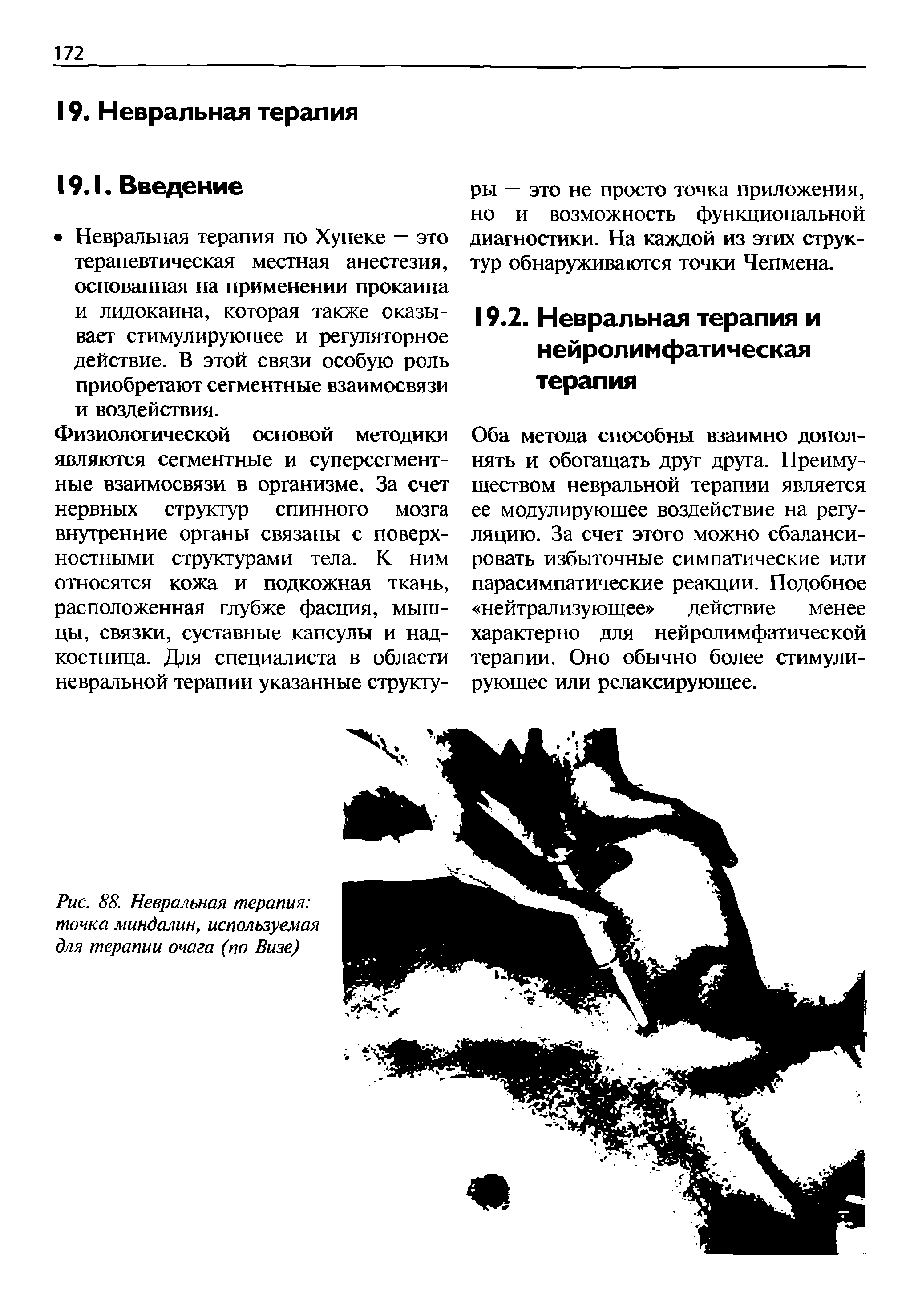 Рис. 88. Невральная терапия точка миндалин, используемая для терапии очага (по Визе)...