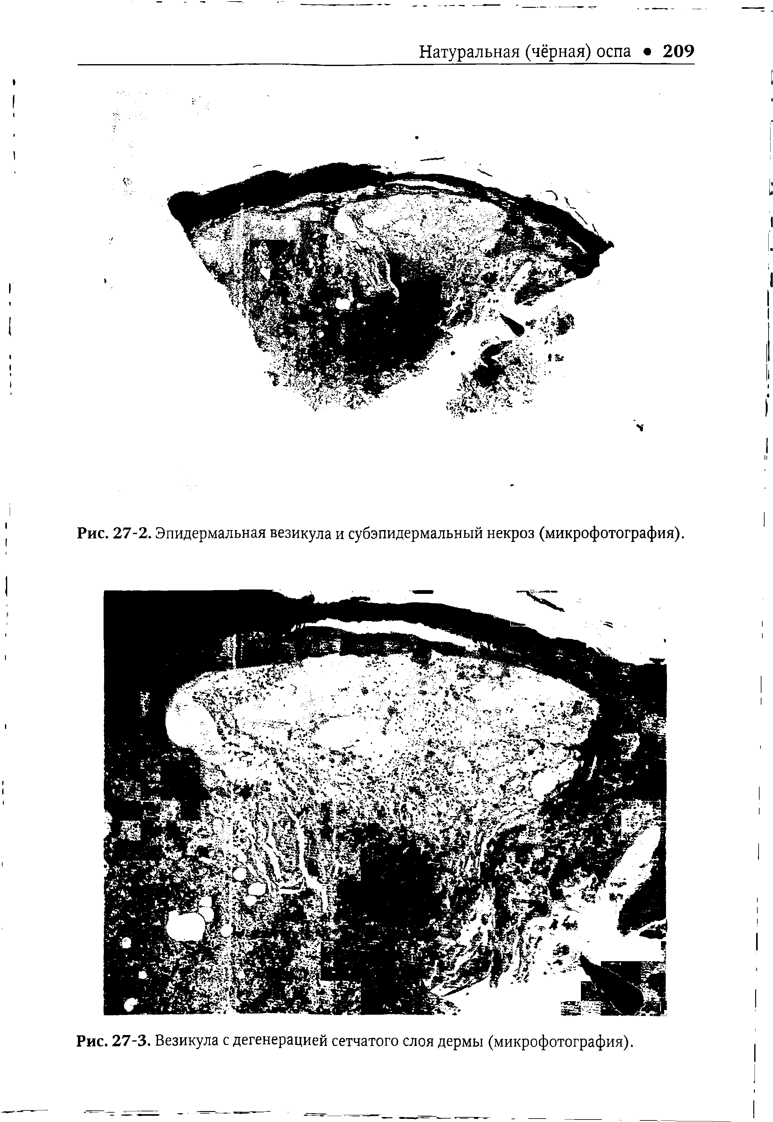 Рис. 27-3. Везикула с дегенерацией сетчатого слоя дермы (микрофотография).