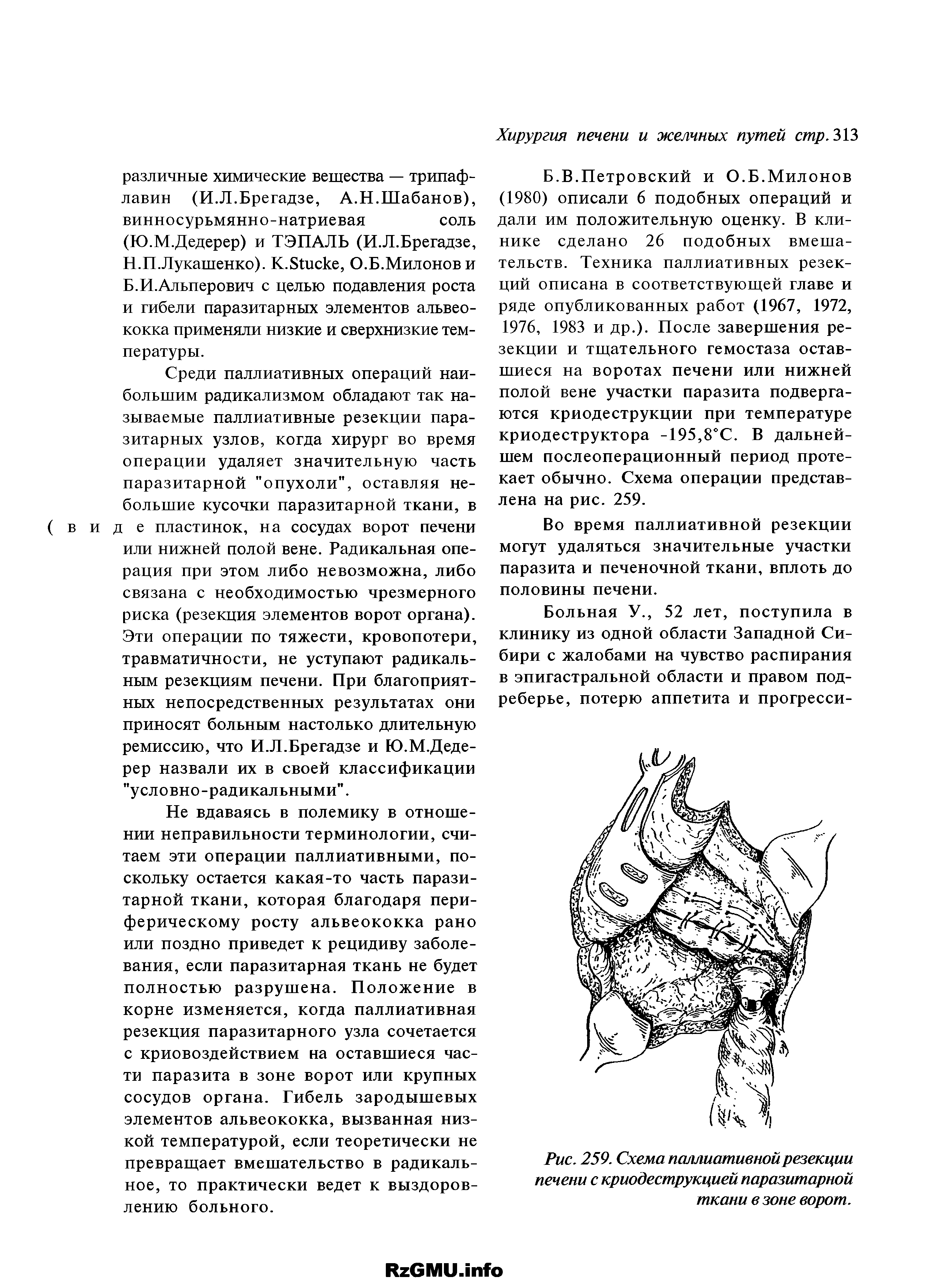 Рис. 259. Схема паллиативной резекции печени с криодеструкцией паразитарной ткани в зоне ворот.