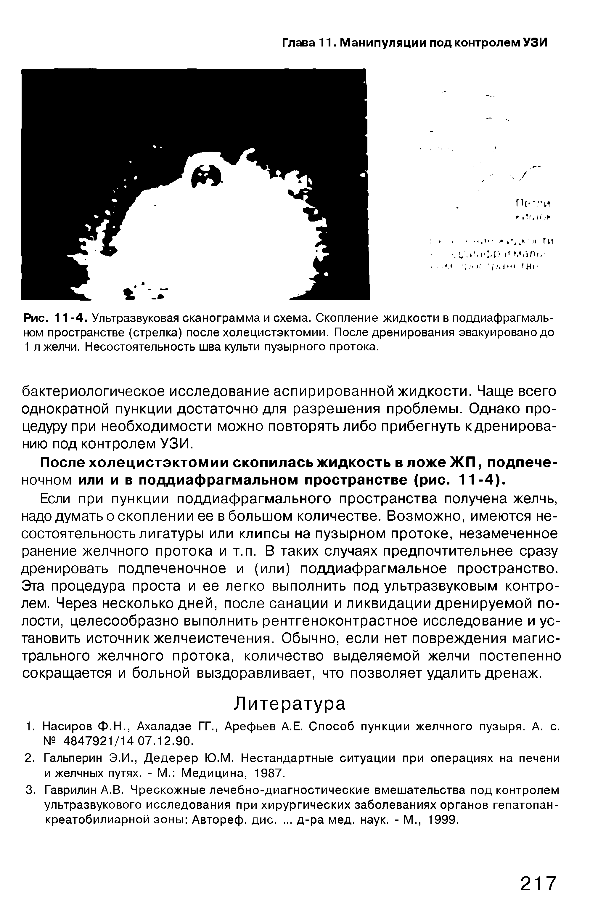 Рис. 11 -4. Ультразвуковая сканограмма и схема. Скопление жидкости в поддиафрагмальном пространстве (стрелка) после холецистэктомии. После дренирования эвакуировано до 1 л желчи. Несостоятельность шва культи пузырного протока.