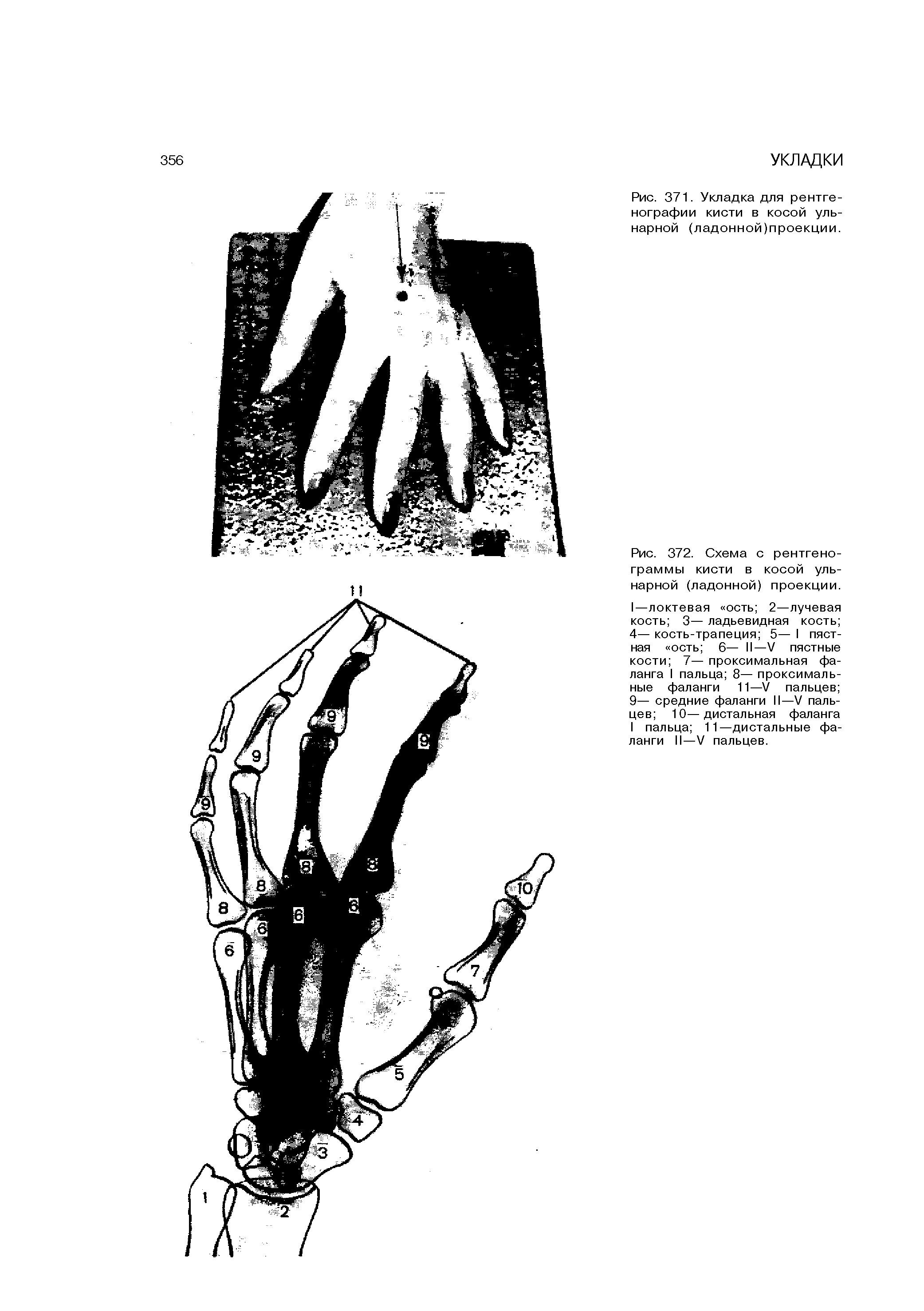 Рис. 372. Схема с рентгенограммы кисти в косой ульнарной (ладонной) проекции.