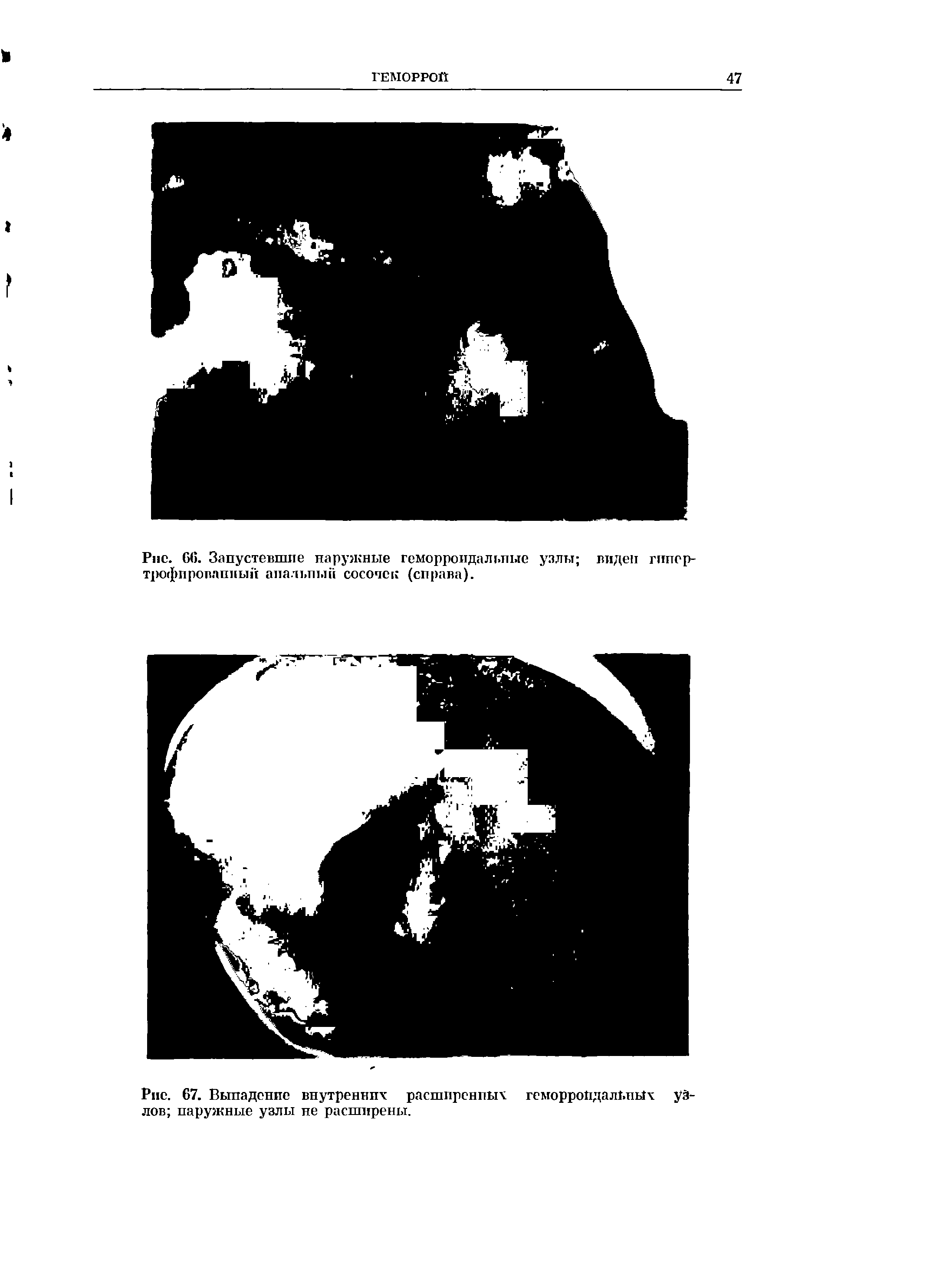 Рис. С>(>. Запустевшие наружные геморроидальные узлы виден гипертрофированный анальный сосочек (справа).