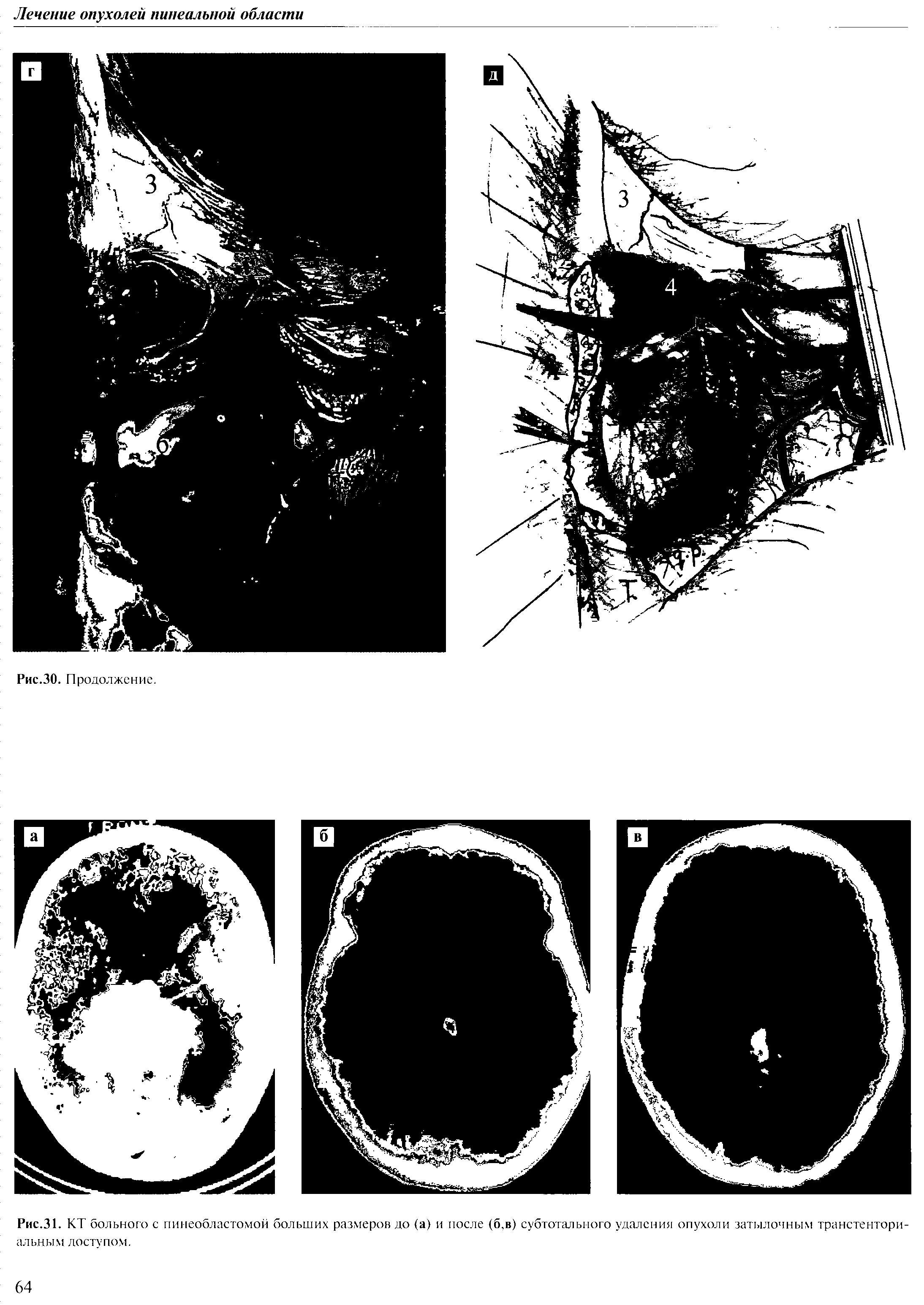 Рис.31. КТ больного с пинеобластомой больших размеров до (а) и после (б,в) субтотального удаления опухоли затылочным транстенториальным доступом.
