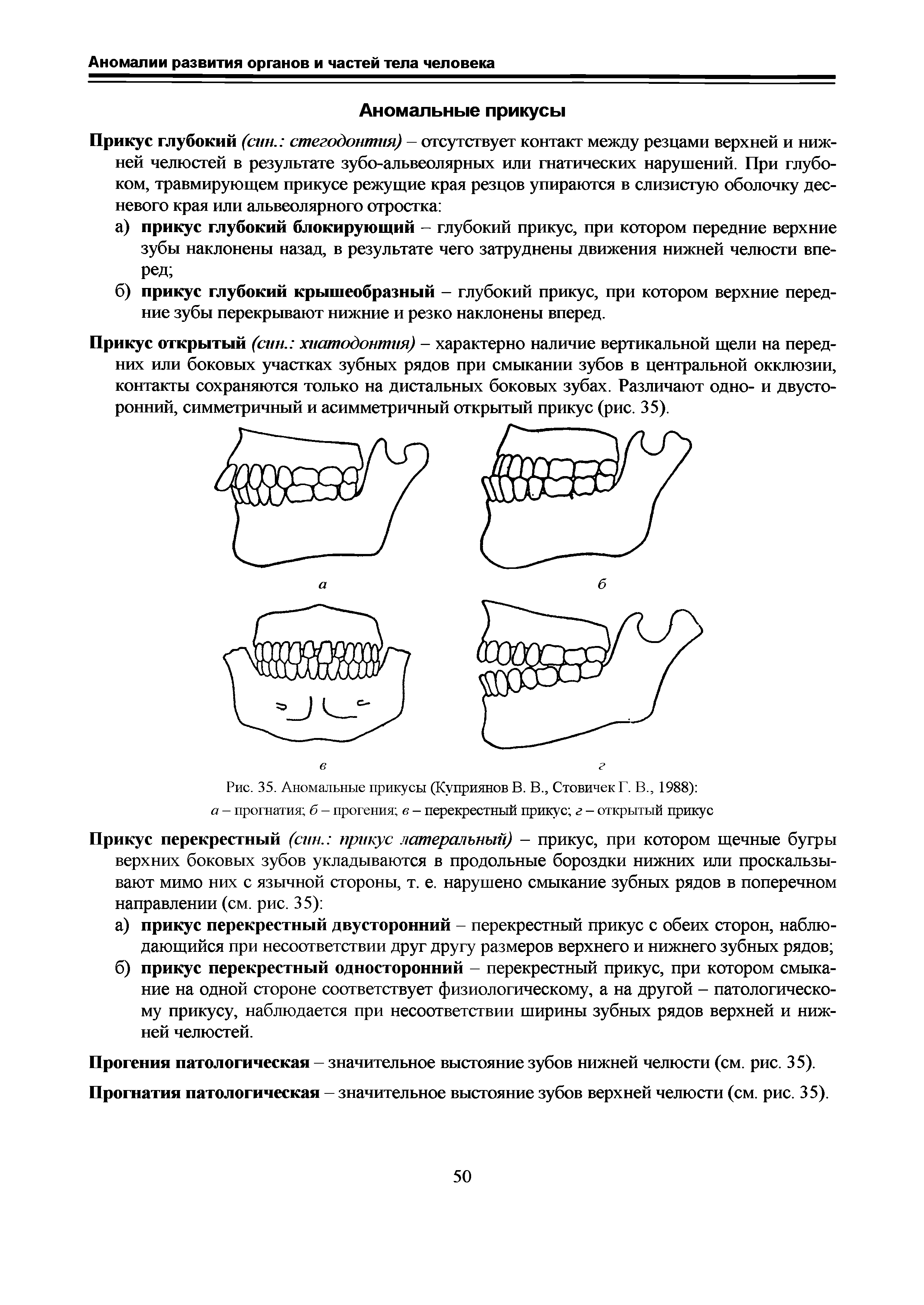 Рис. 35. Аномальные прикусы (Куприянов В. В., СтовичекГ. В., 1988) а - прогнатия б - прогения в - перекрестный прикус г - открытый прикус...