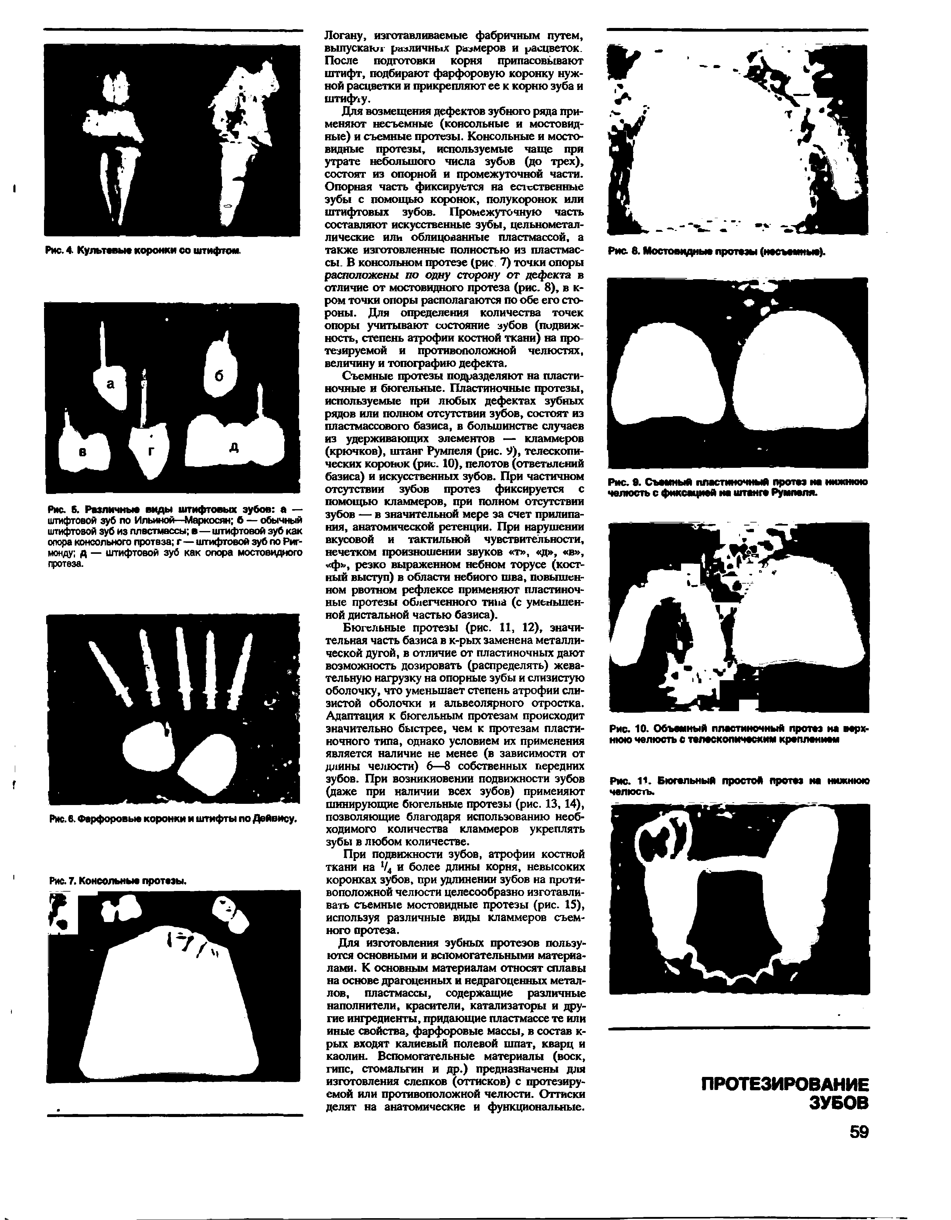 Рис. Б. Различные виды штифтовых зубов а — штифтовой зуб по Ильиной—Маркосян б — обычный штифтовой зуб из пластмассы в—штифтовой зуб как опора консольного протеза г—штифтовой зуб по Риг-монду д — штифтовой зуб как опора мостовидного протеза.