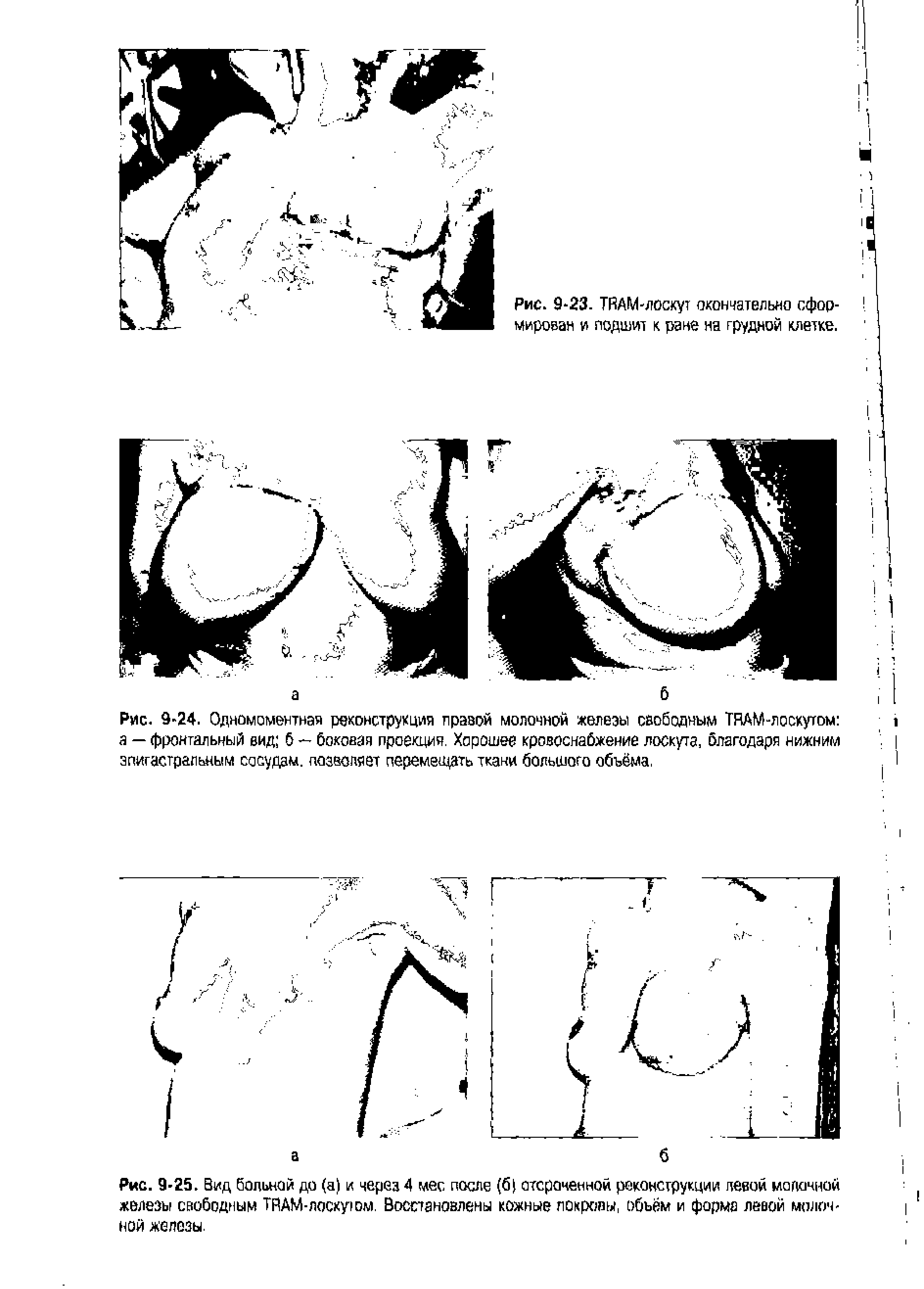 Рис. 9-24. Одномоментная реконструкция правой молочной железы свободным TRAM-лоскутом а — фронтальный вид б — боковая проекция. Хорошее кровоснабжение лоскута, благодаря нижним эпигастральным сосудам, позволяет перемещать ткани большого объёма,...