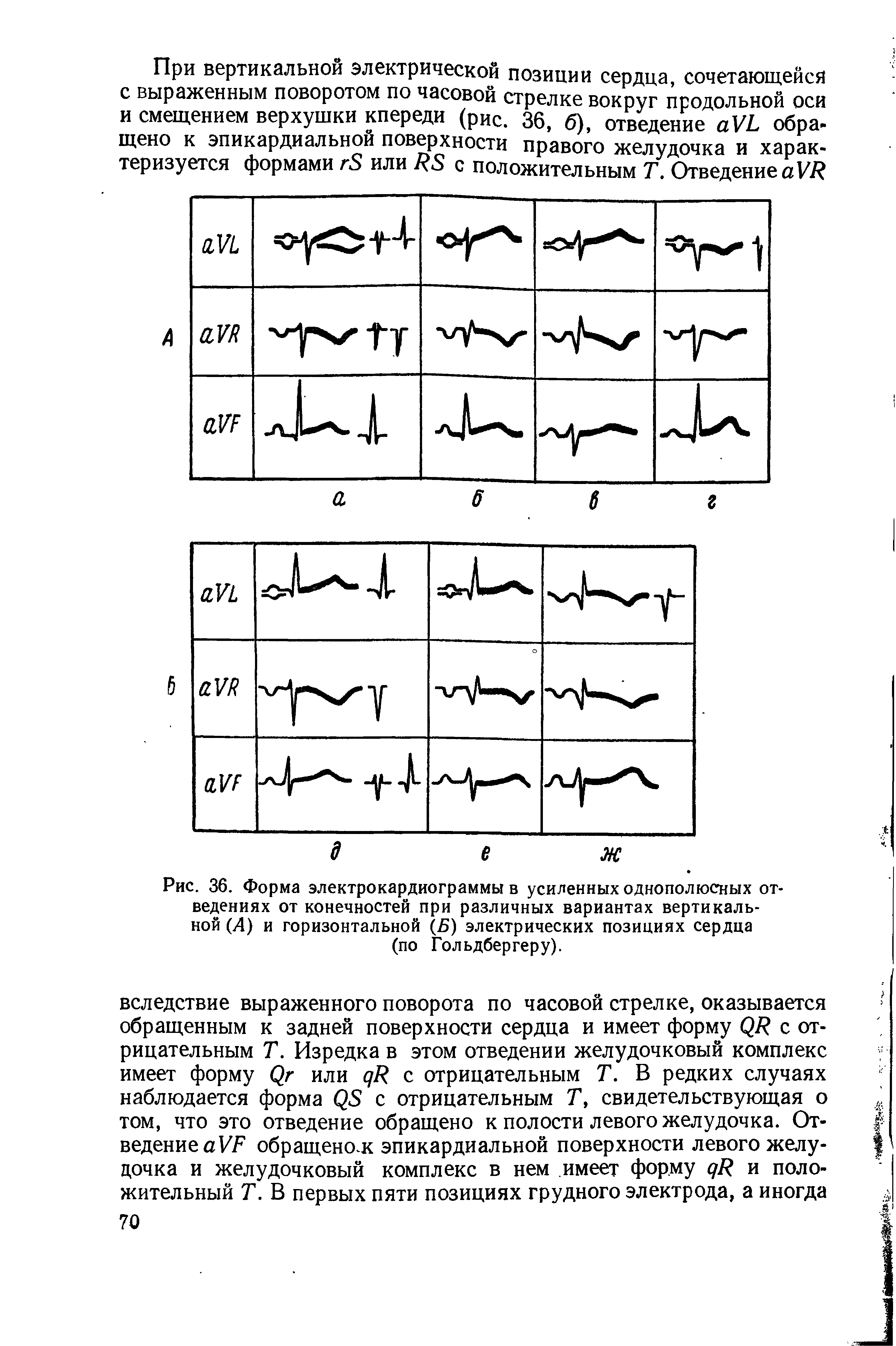 Рис. 36. Форма электрокардиограммы в усиленных однополюсных отведениях от конечностей при различных вариантах вертикальной (А) и горизонтальной (Б) электрических позициях сердца (по Гольдбергеру).