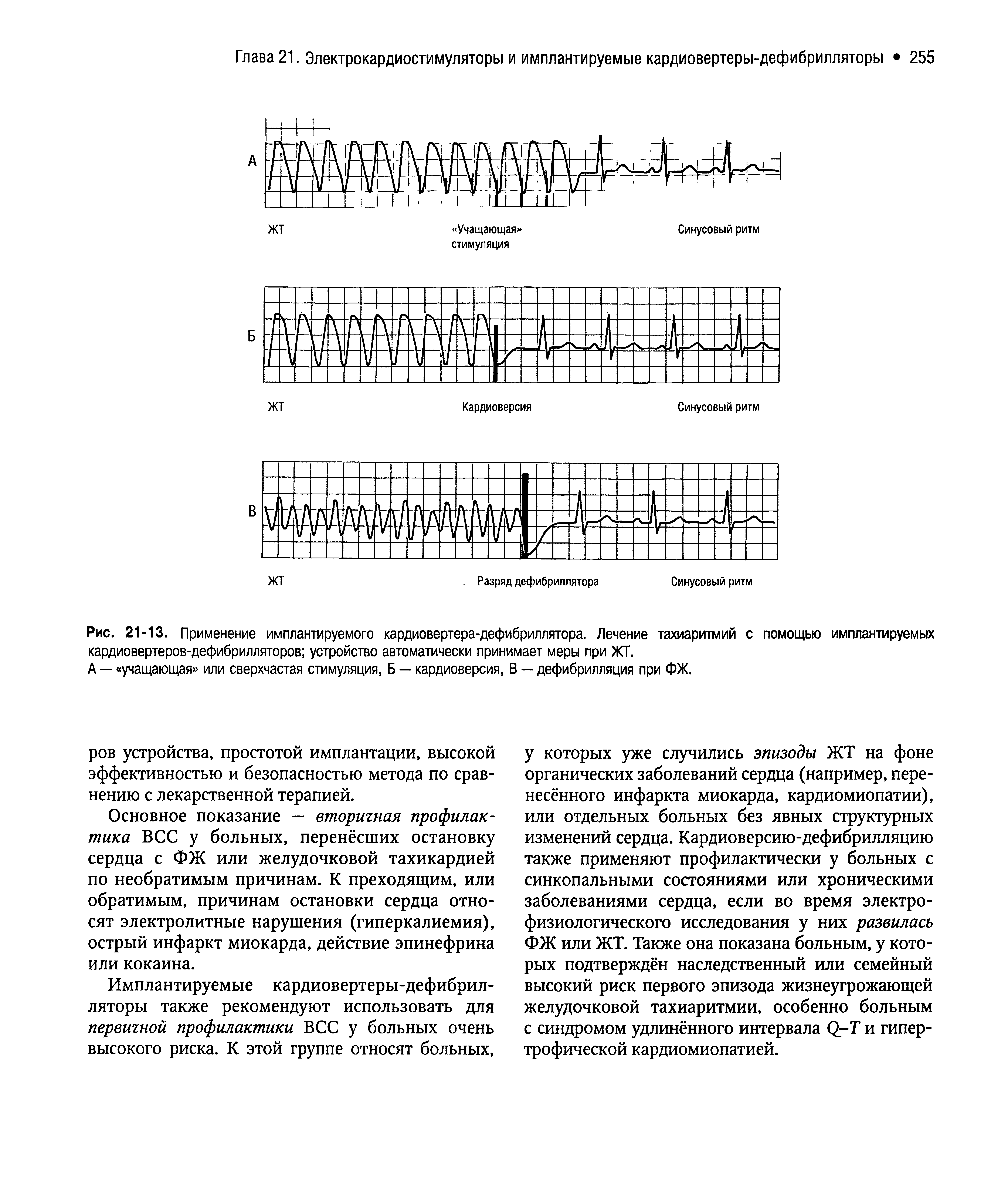 Рис. 21-13. Применение имплантируемого кардиовертера-дефибриллятора. Лечение тахиаритмий с помощью имплантируемых кардиовертеров-дефибрилляторов устройство автоматически принимает меры при ЖТ.