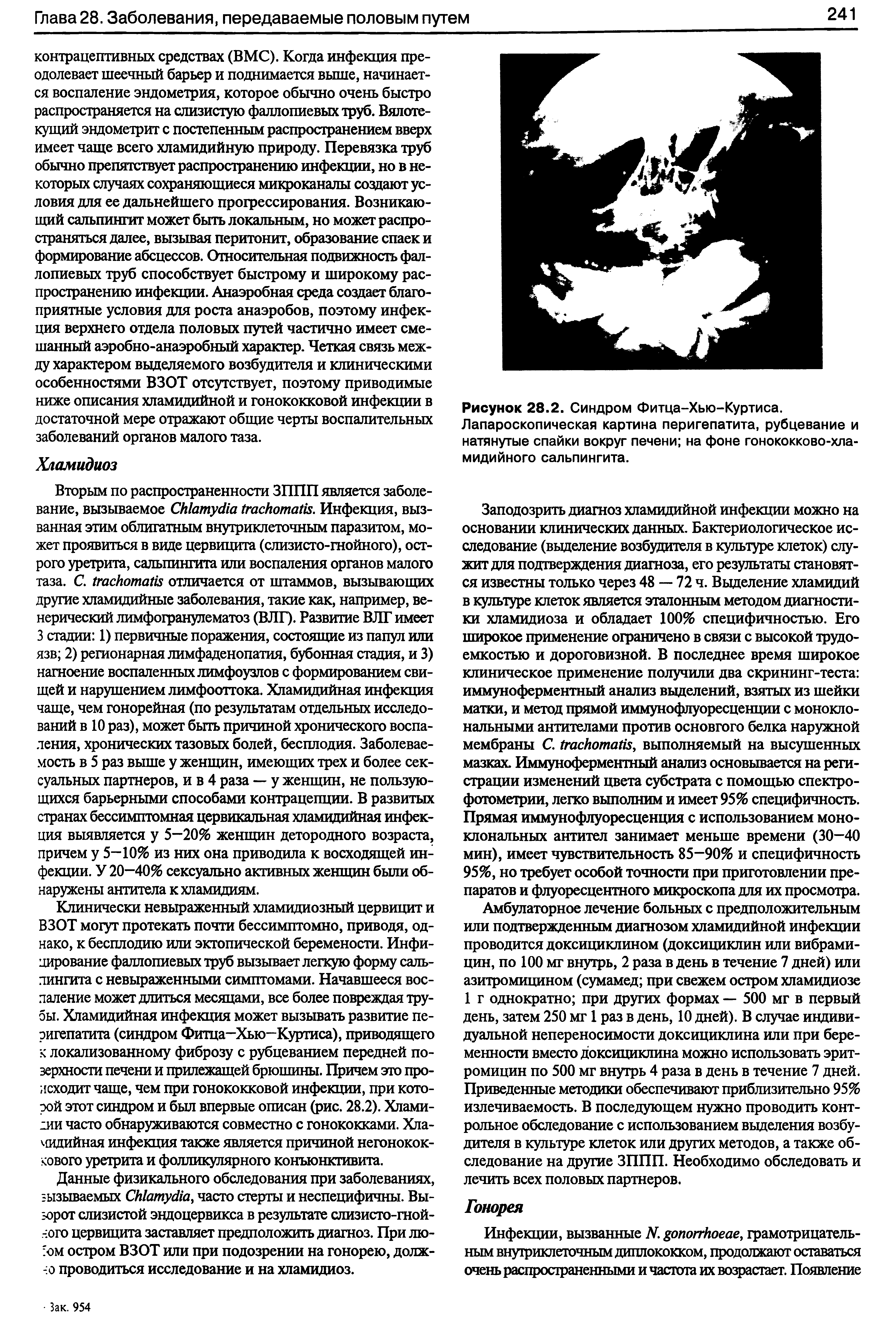 Рисунок 28.2. Синдром Фитца-Хью-Куртиса. Лапароскопическая картина перигепатита, рубцевание и натянутые спайки вокруг печени на фоне гонококково-хламидийного сальпингита.