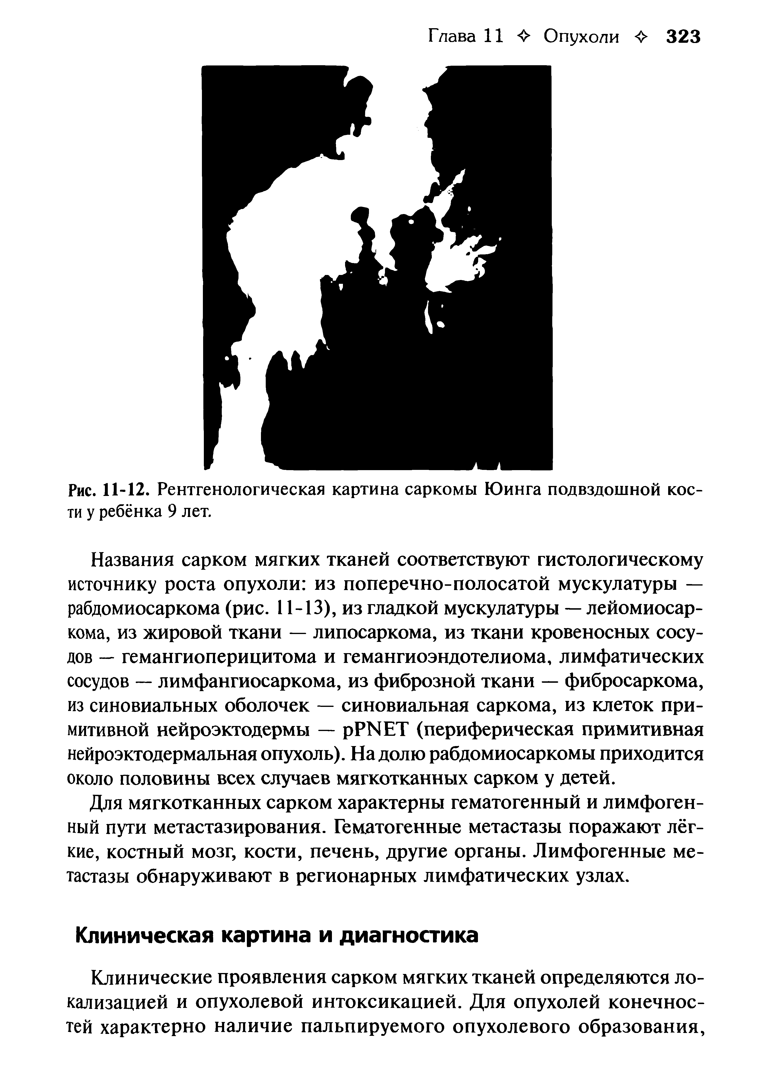 Рис. 11-12. Рентгенологическая картина саркомы Юинга подвздошной кости у ребёнка 9 лет.