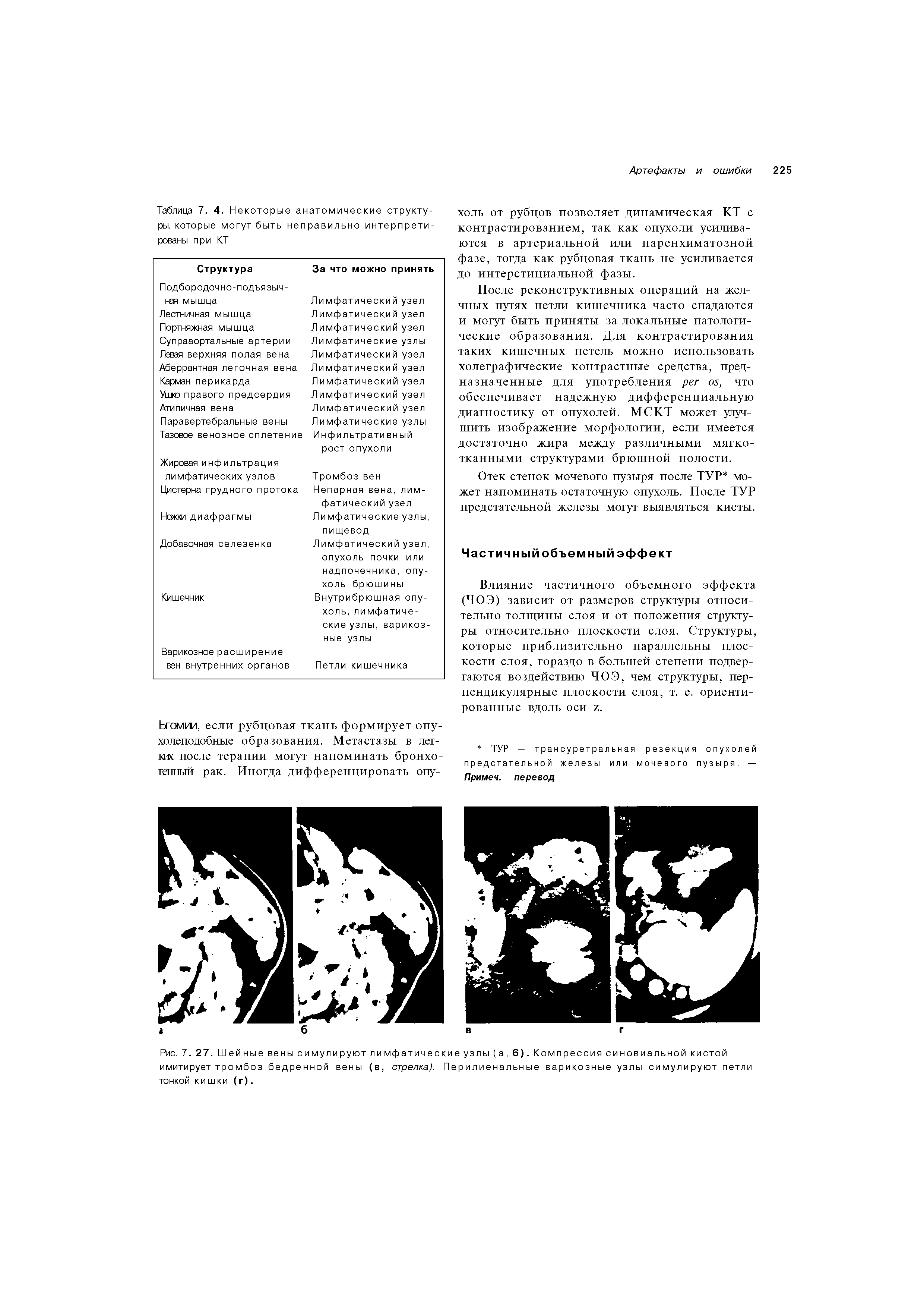 Рис. 7. 27. Шейные вены симулируют лимфатические узлы (а, 6). Компрессия синовиальной кистой имитирует тромбоз бедренной вены (в, стрелка). Перилиенальные варикозные узлы симулируют петли тонкой кишки (г).