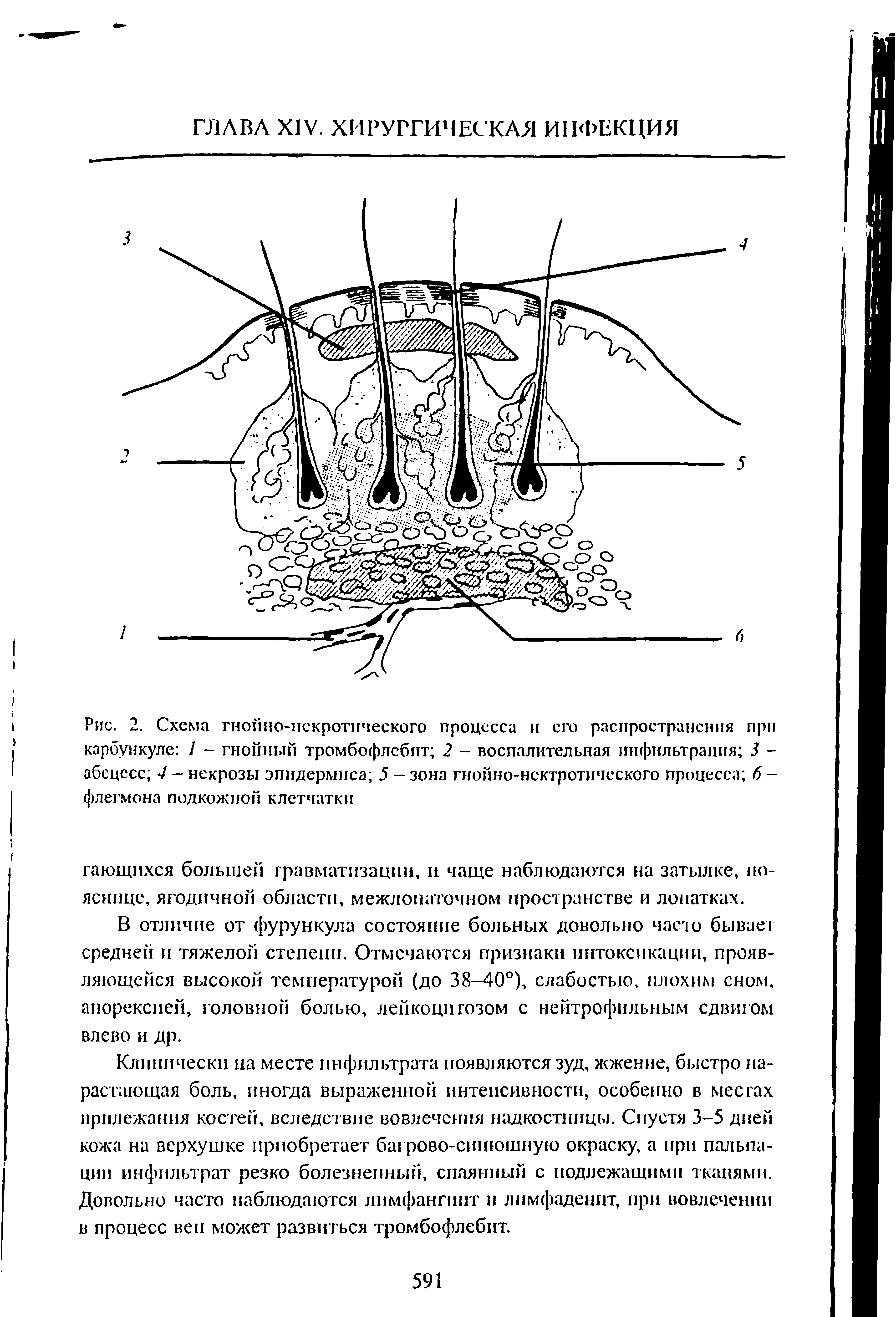 Рис. 2. Схема гнойно-нскротического процесса и его распространения при карбункуле / - гнойный тромбофлебит 2 - воспалительная инфильтрация 3 -абсцесс 4 - некрозы эпидермиса 5 - зона гнойно-нсктротического процесса 6 -флегмона подкожной клетчатки...