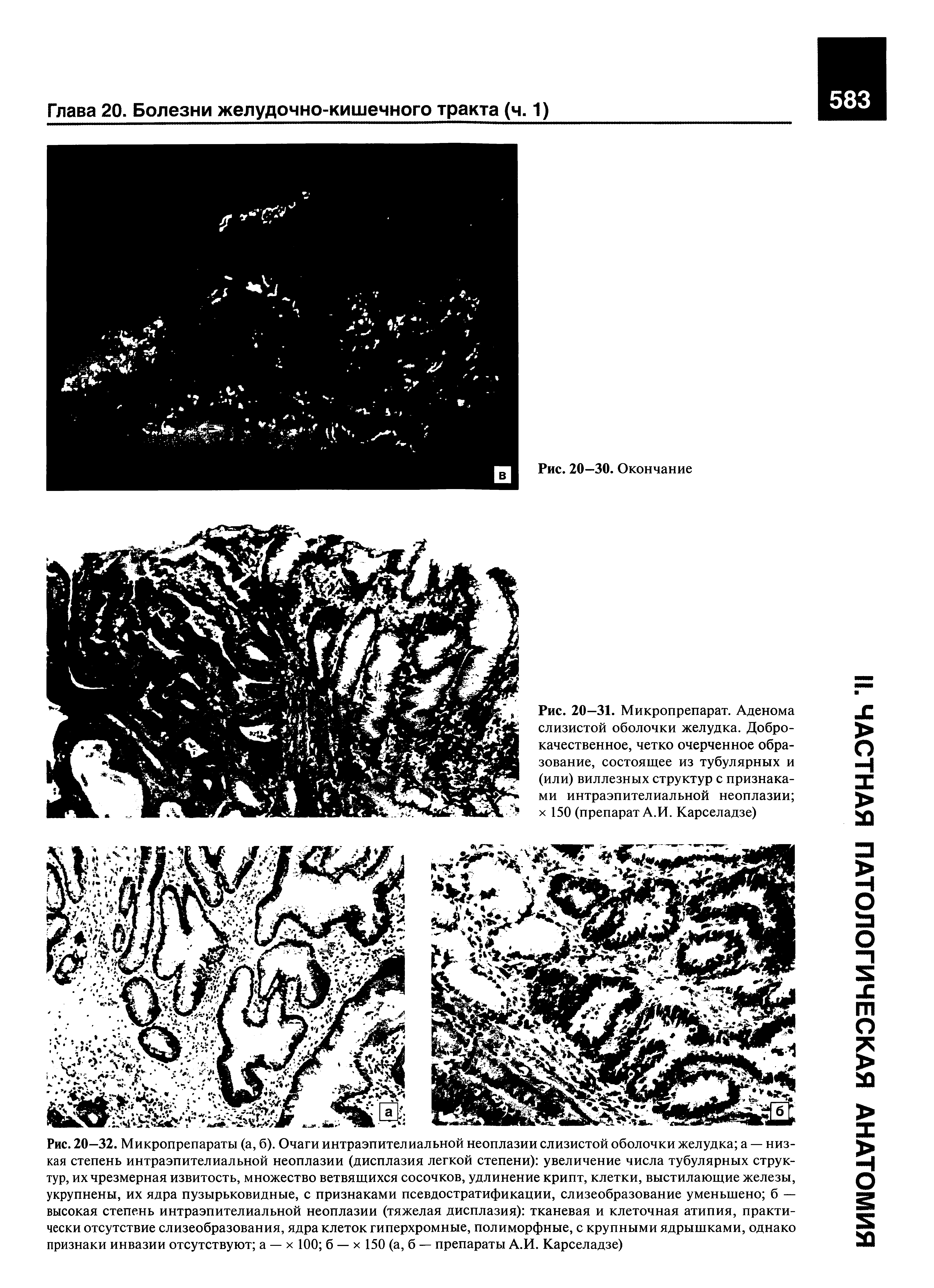 Рис. 20—31. Микропрепарат. Аденома слизистой оболочки желудка. Доброкачественное, четко очерченное образование, состоящее из тубулярных и (или) виллезных структур с признаками интраэпителиальной неоплазии х 150 (препарат А.И. Карселадзе)...