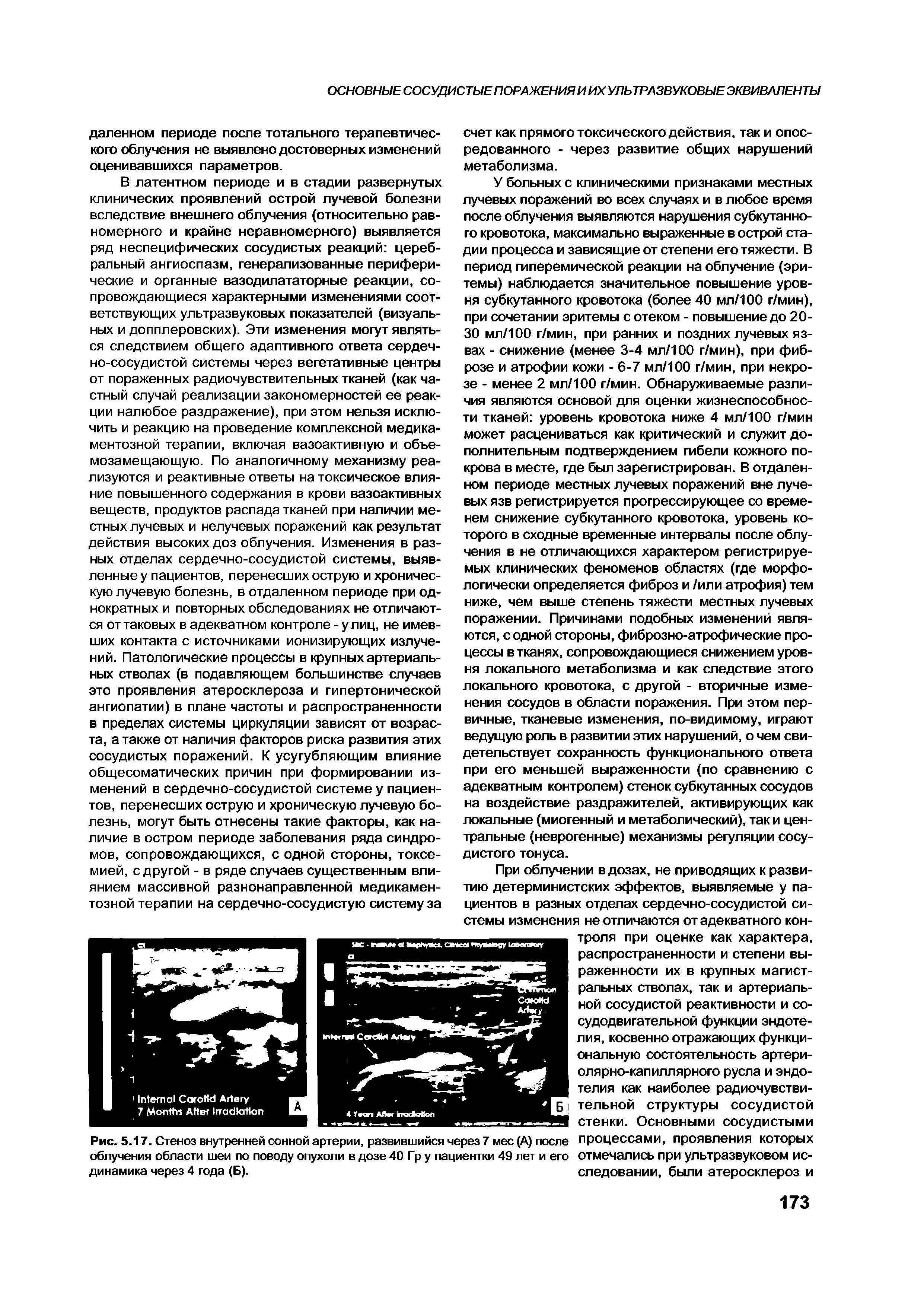 Рис. 5.17. Стеноз внутренней сонной артерии, развившийся через 7 мес (А) после облучения области шеи по поводу опухоли в дозе 40 Гр у пациентки 49 лет и его динамика через 4 года (Б).