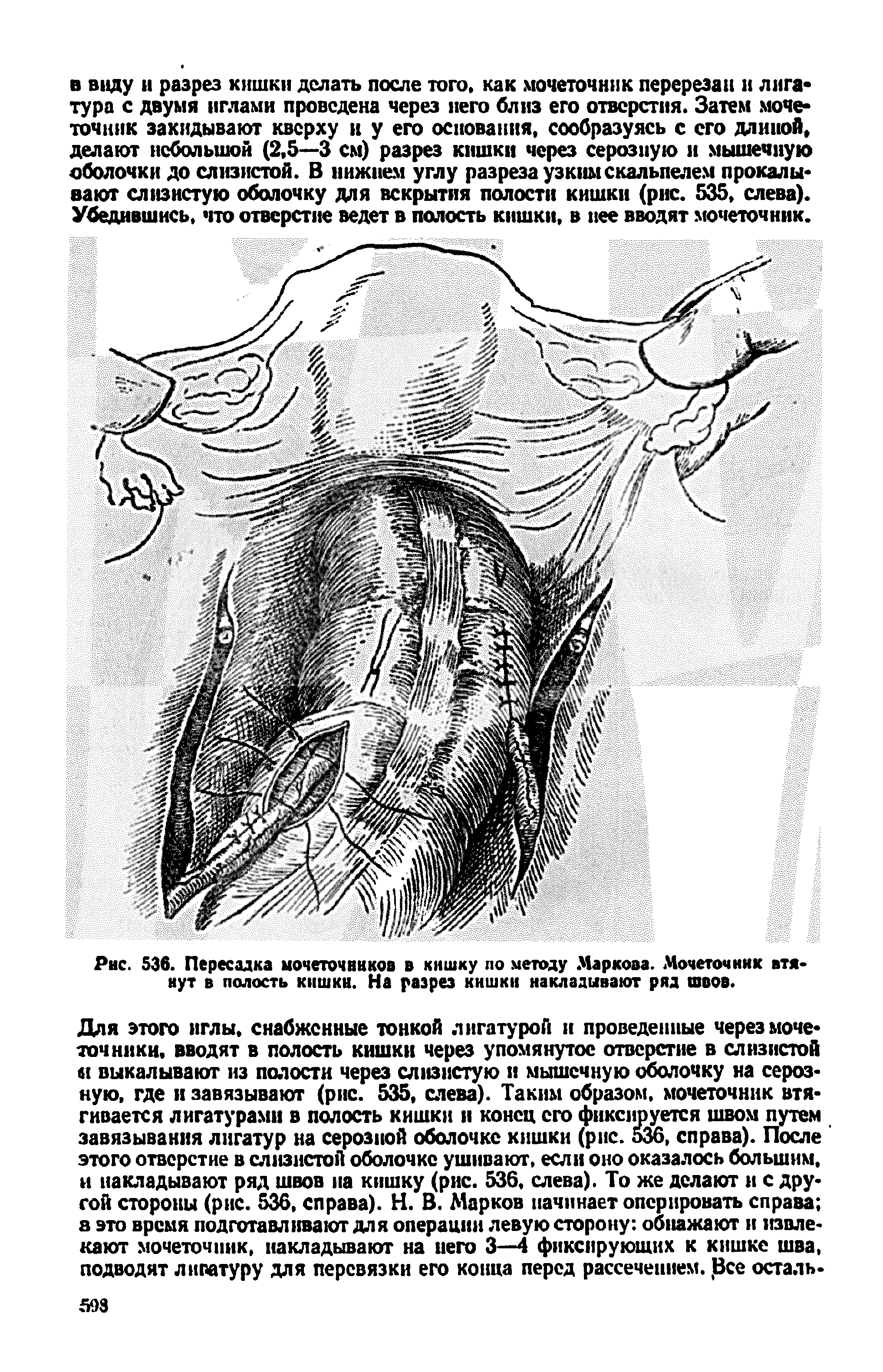 Рис. 536. Пересадка мочеточников в кишку по методу Маркова. Мочеточник втянут в полость кншкн. На разрез кишки накладывают ряд швов.