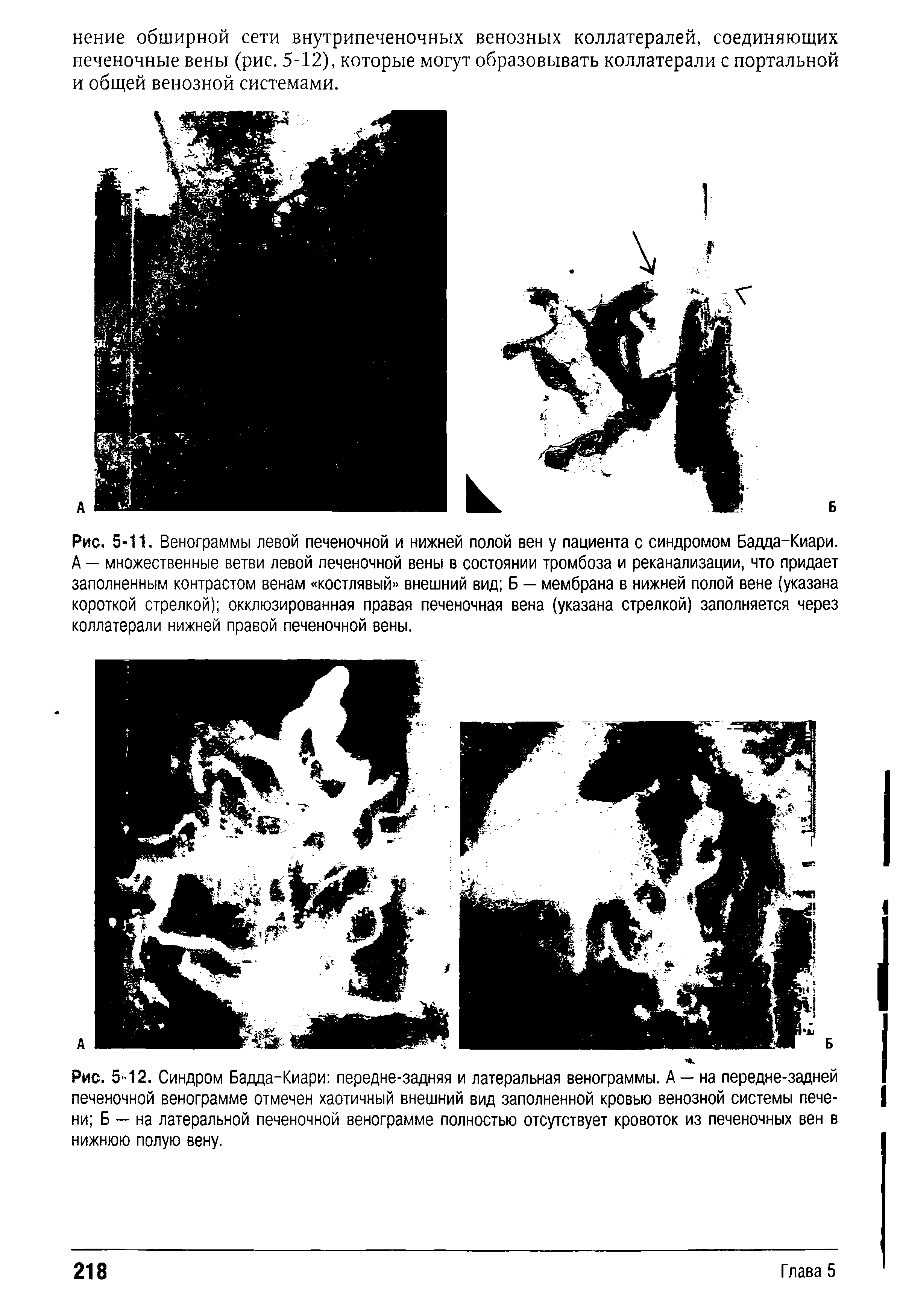 Рис. 5 12. Синдром Бадда-Киари передне-задняя и латеральная венограммы. А — на передне-задней печеночной венограмме отмечен хаотичный внешний вид заполненной кровью венозной системы печени Б — на латеральной печеночной венограмме полностью отсутствует кровоток из печеночных вен в нижнюю полую вену.