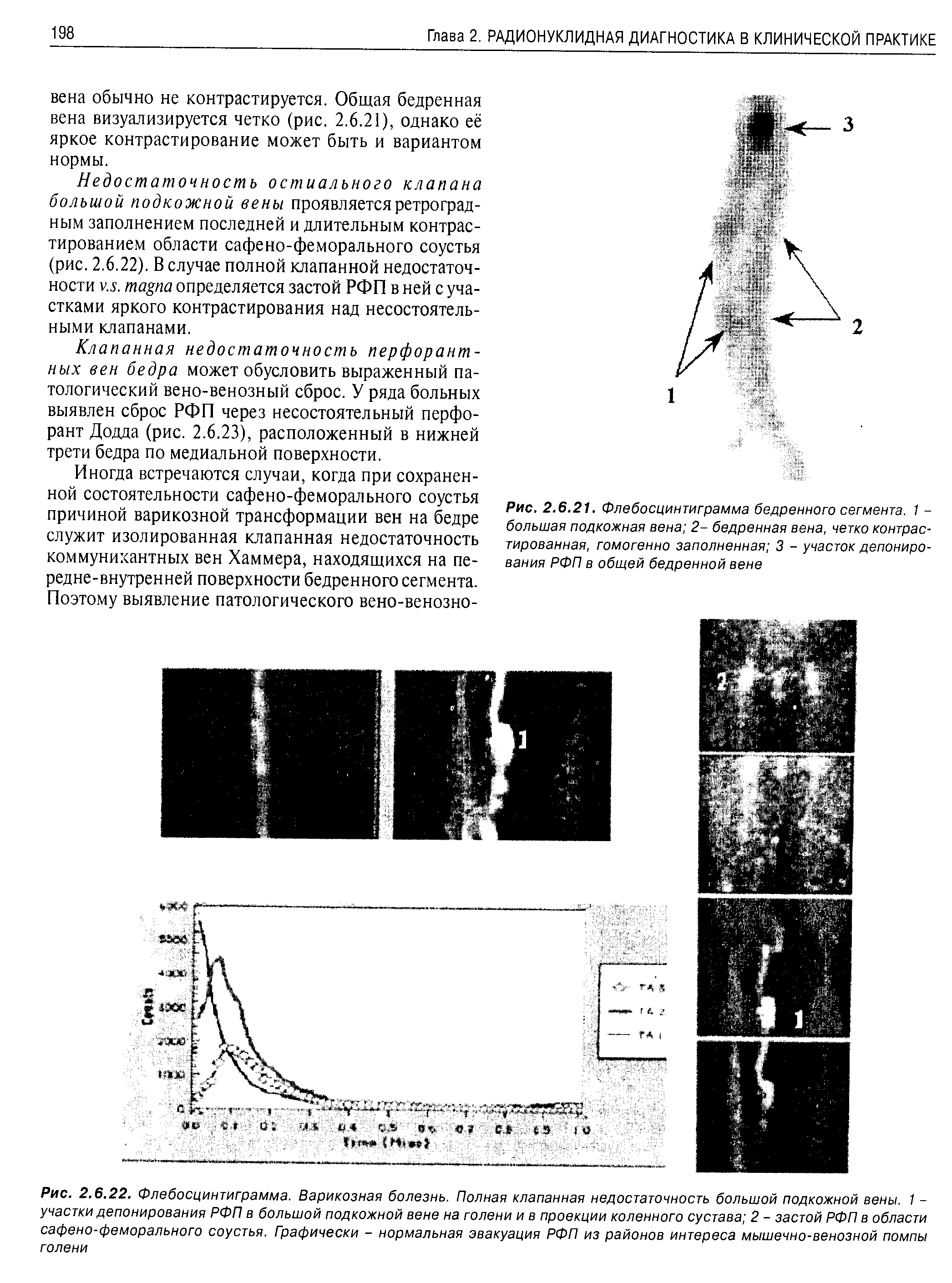 Рис. 2.6.21. Флебосцинтиграмма бедренного сегмента. 1 -большая подкожная вена 2- бедренная вена, четко контрастированная, гомогенно заполненная 3 - участок депонирования РФП в общей бедренной вене...