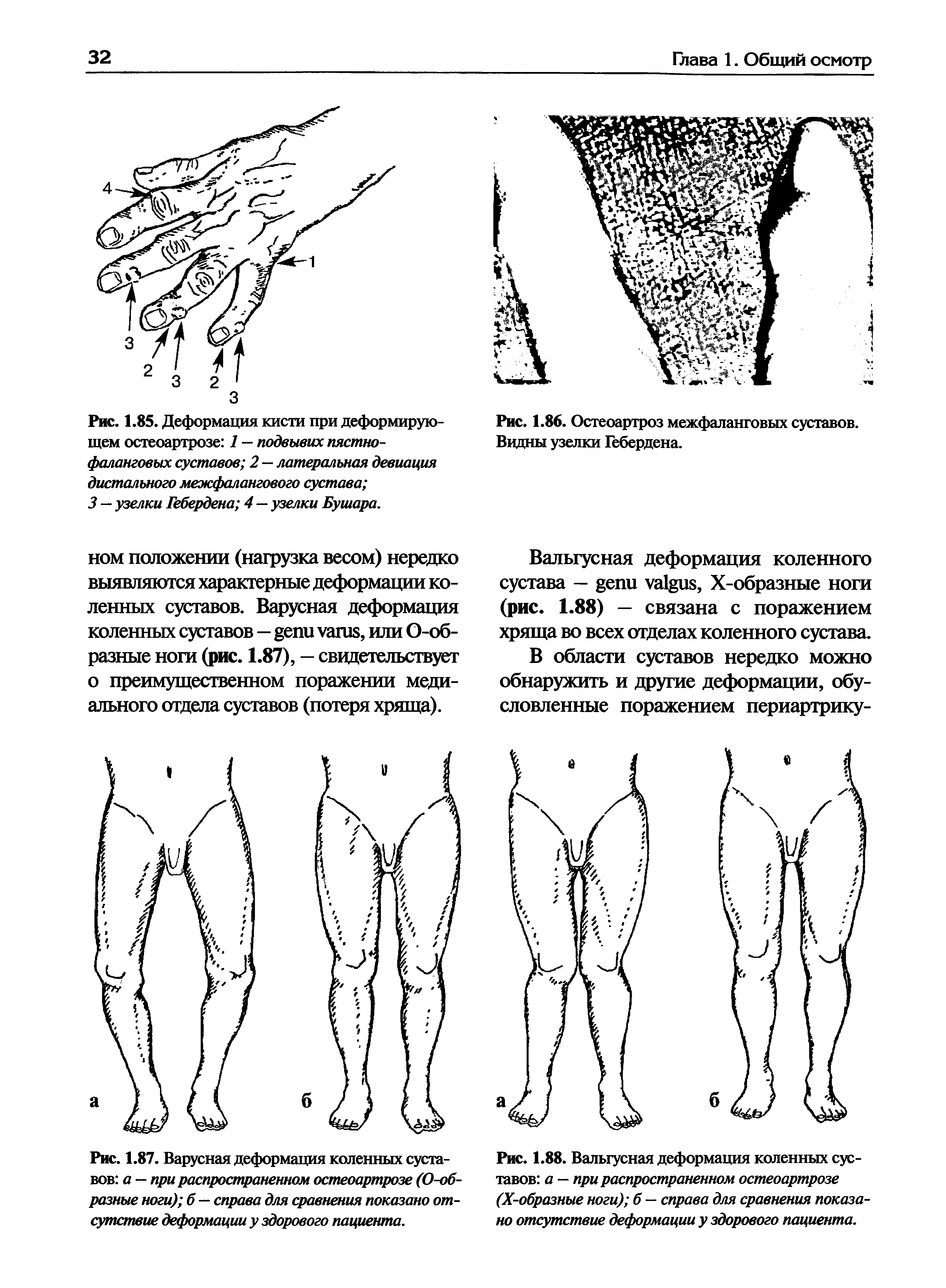 Рис. 1.87. Варусная деформация коленных суставов а — при распространенном остеоартрозе (О-об-разные ноги) б — справа для сравнения показано отсутствие деформации у здорового пациента.