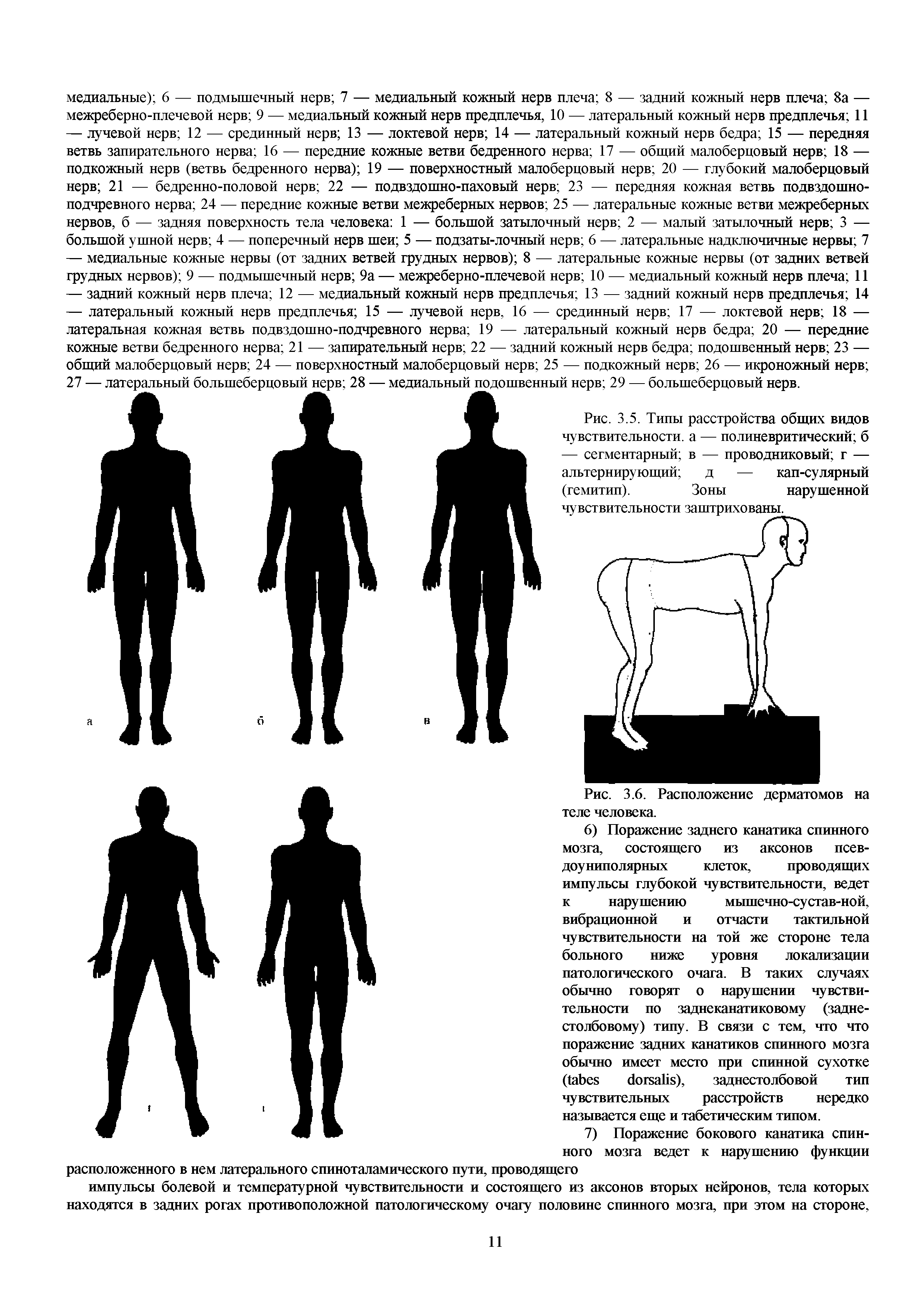 Рис. 3.5. Типы расстройства общих видов чувствительности, а — полиневритический б — сегментарный в — проводниковый г — альтернирующий д — кап-сулярный (гемитип). Зоны нарушенной...