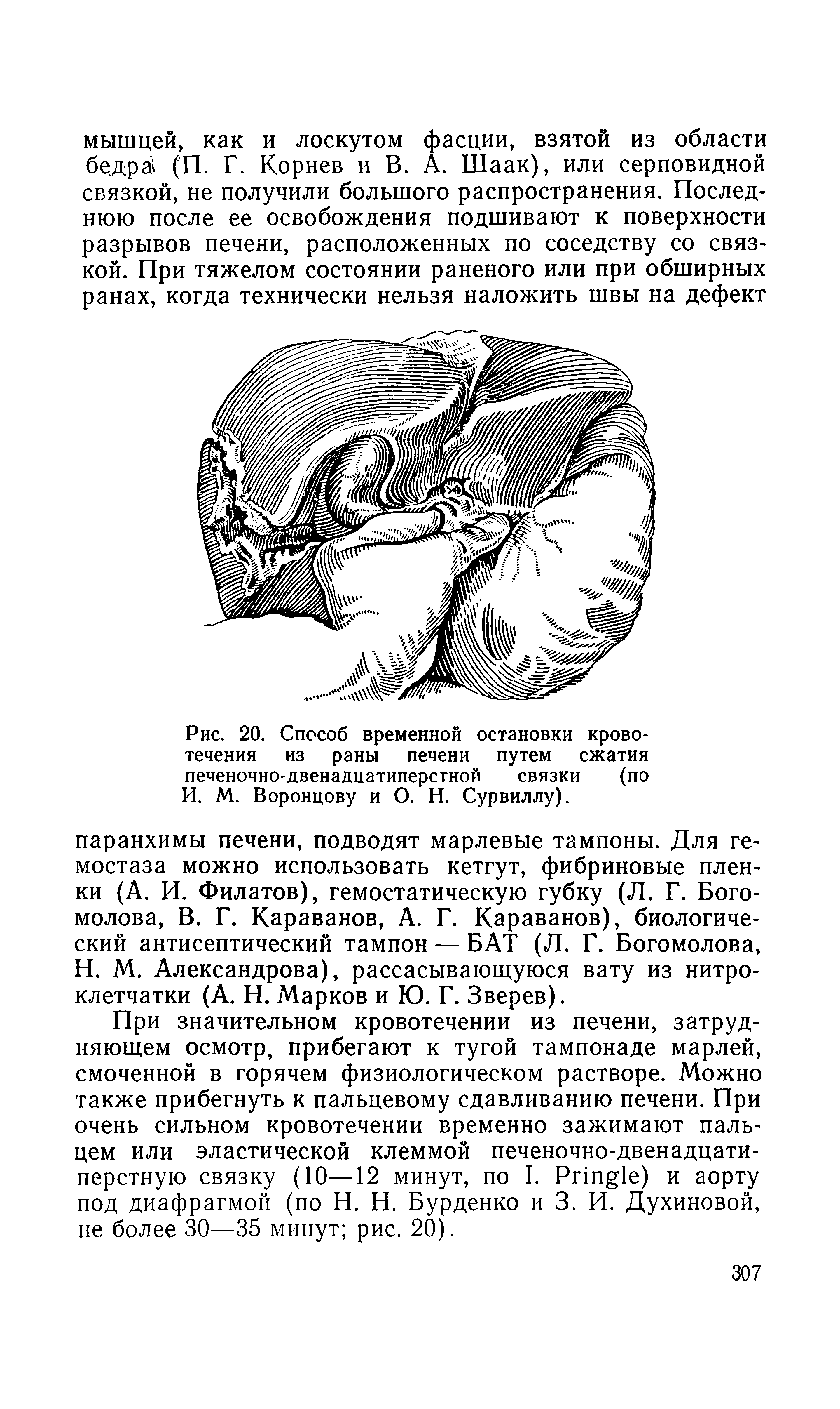 Рис. 20. Способ временной остановки кровотечения из раны печени путем сжатия печеночно-двенадцатиперстной связки (по И. М. Воронцову и О. Н. Сурвиллу).