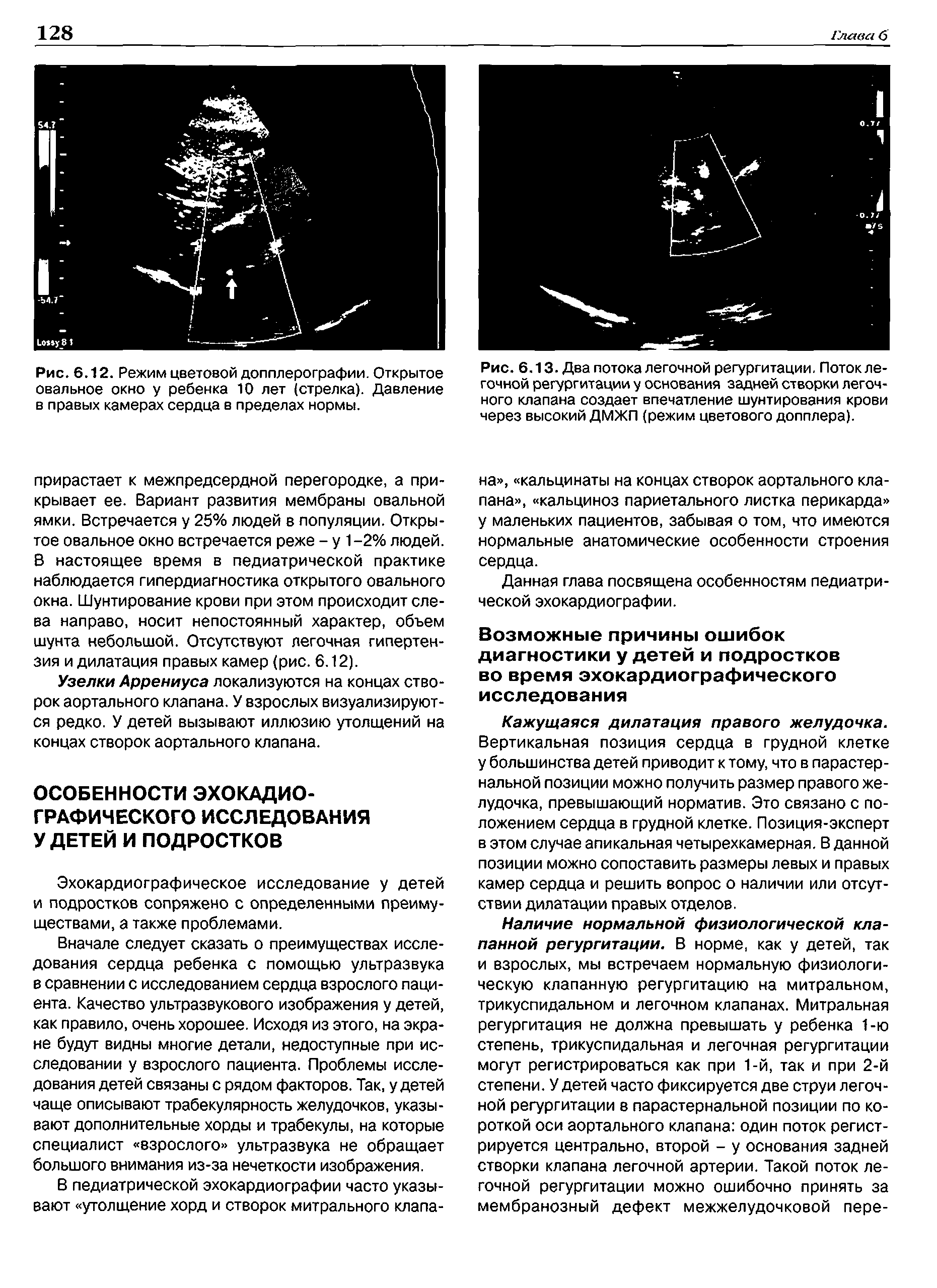 Рис. 6.12. Режим цветовой допплерографии. Открытое овальное окно у ребенка 10 лет (стрелка). Давление в правых камерах сердца в пределах нормы.