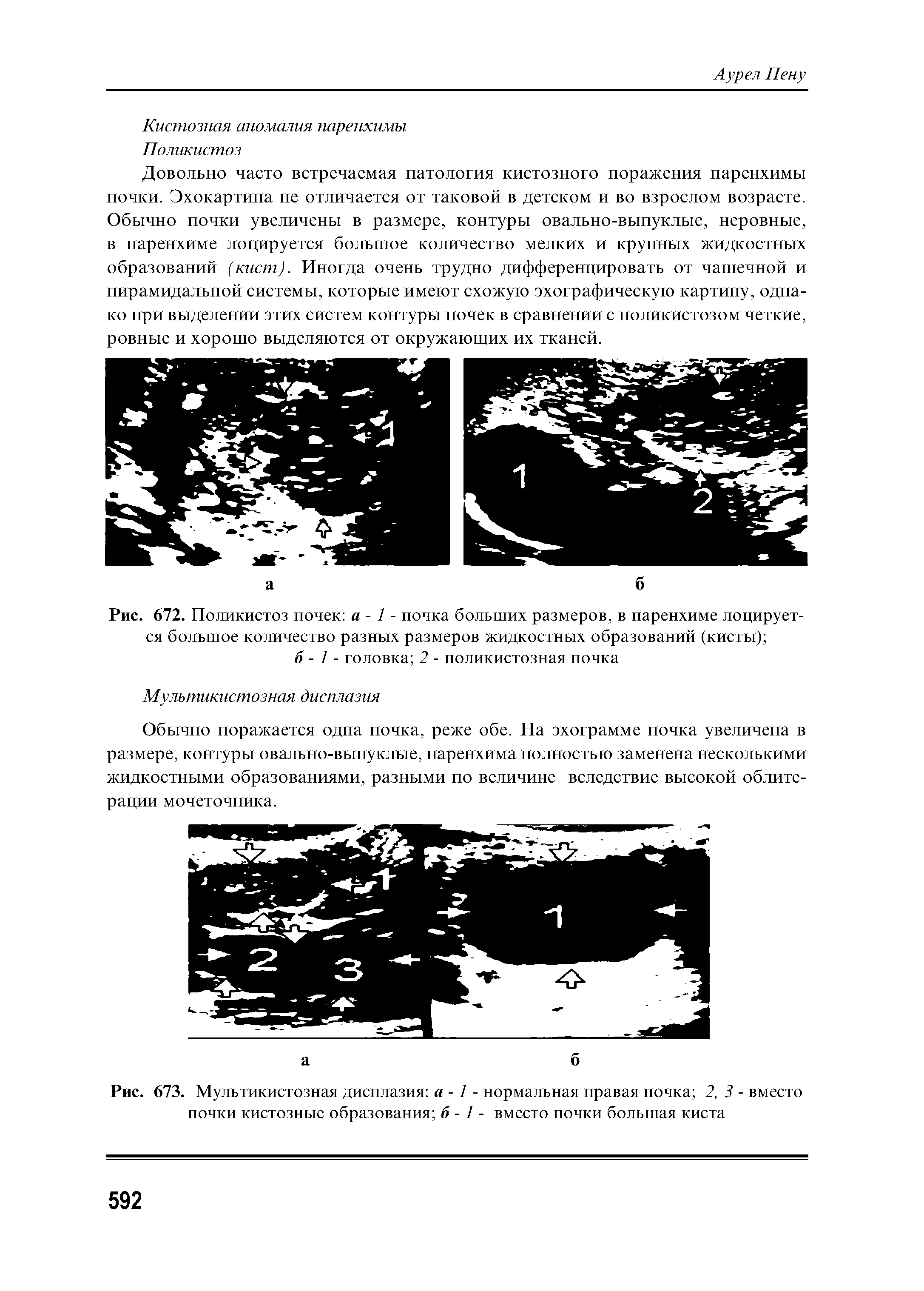 Рис. 673. Мультикистозная дисплазия а -1 - нормальная правая почка 2, 3 - вместо почки кистозные образования б -1 - вместо почки большая киста...