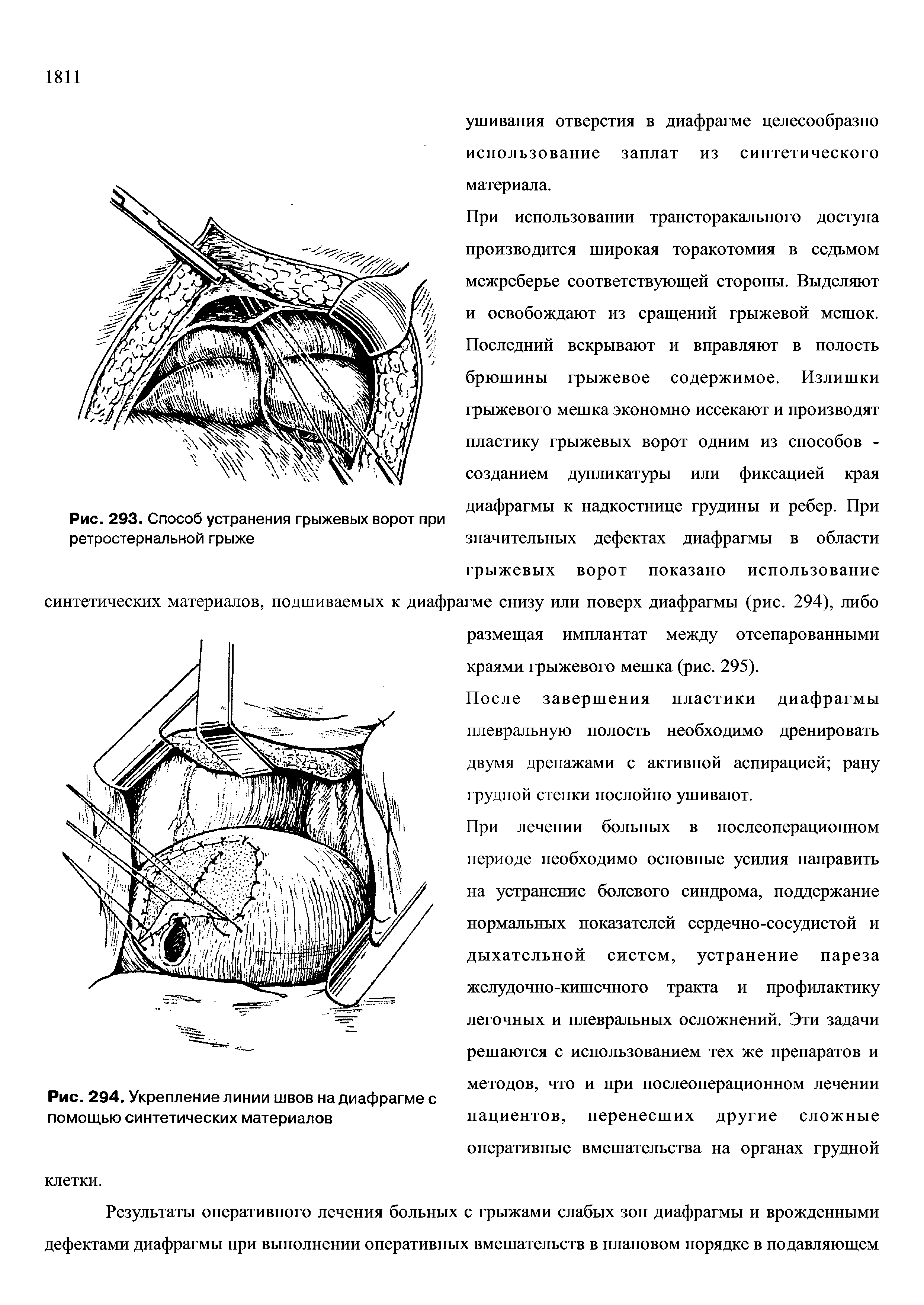 Рис. 293. Способ устранения грыжевых ворот при ретростернальной грыже...