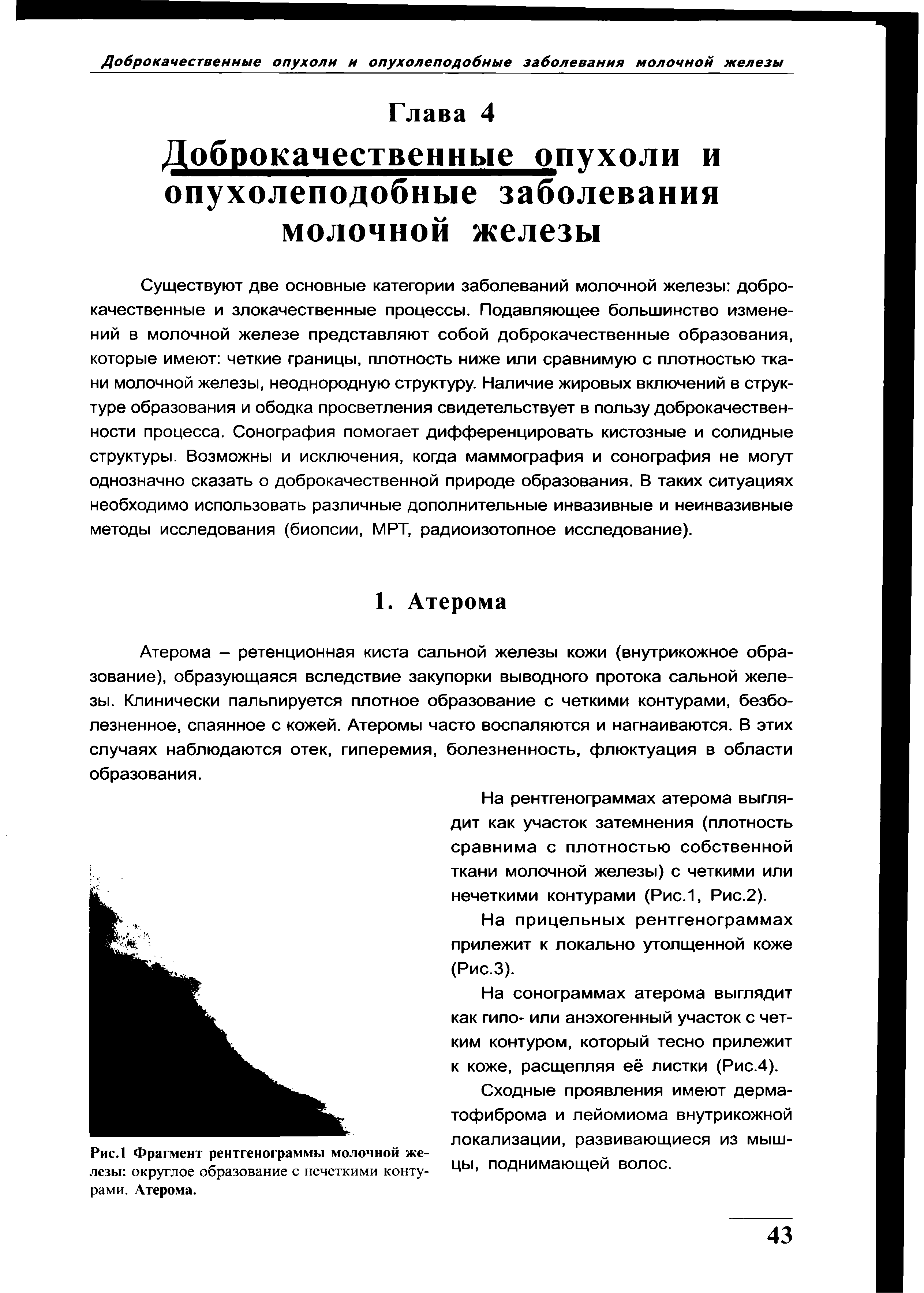 Рис.1 Фрагмент рентгенограммы молочной железы округлое образование с нечеткими контурами. Атерома.