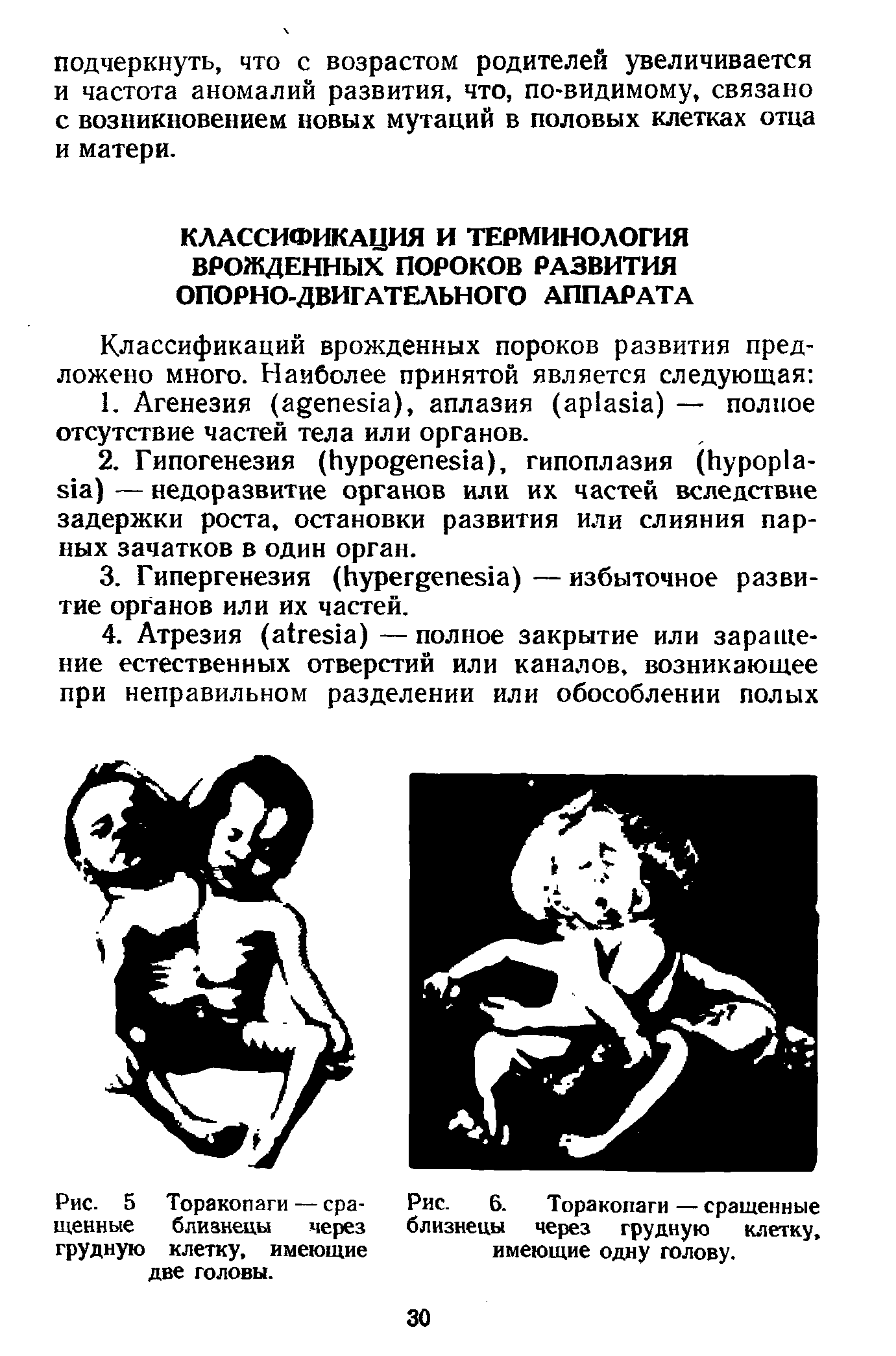 Рис. 5 Торакопаги — сращенные близнецы через грудную клетку, имеющие две головы.