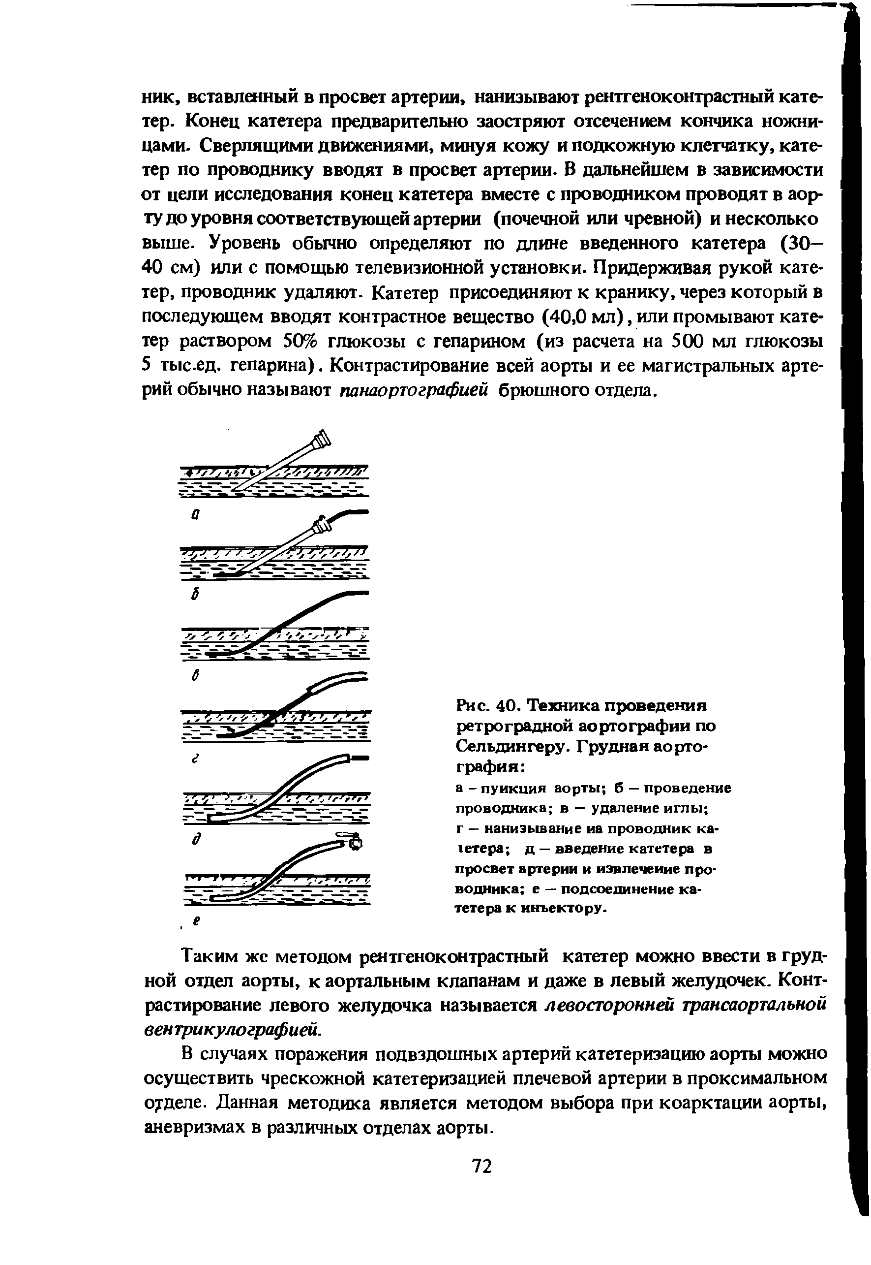 Рис. 40. Техника проведения ретроградной аортографии по Сельдингеру. Грудная аортография ...