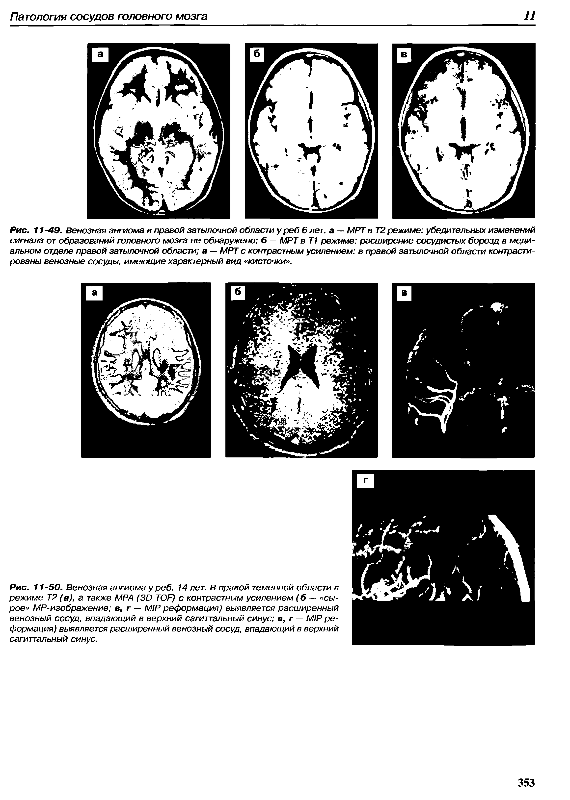Рис. 11-50. Венозная ангиома у реб. 14 лет. в правой теменной области в режиме Т2 (а), а также MPA (3D TOF) с контрастным усилением (б — сырое MP-изображение в, г — MIP реформация) выявляется расширенный венозный сосуд, впадающий в верхний сагиттальный синус в, г — MIP реформация) выявляется расширенный венозный сосуд, впадающий в верхний сагиттальный синус.