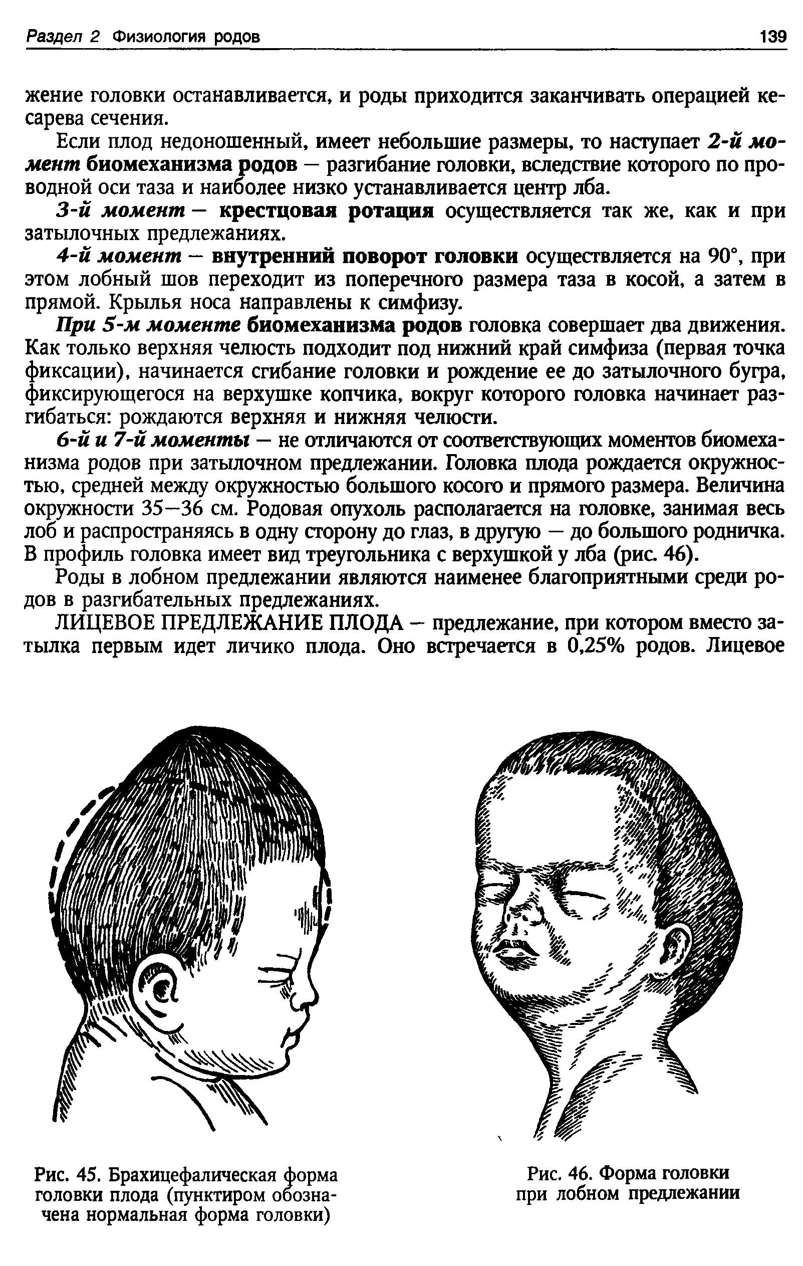 Рис. 45. Брахицефалическая форма головки плода (пунктиром обозначена нормальная форма головки)...