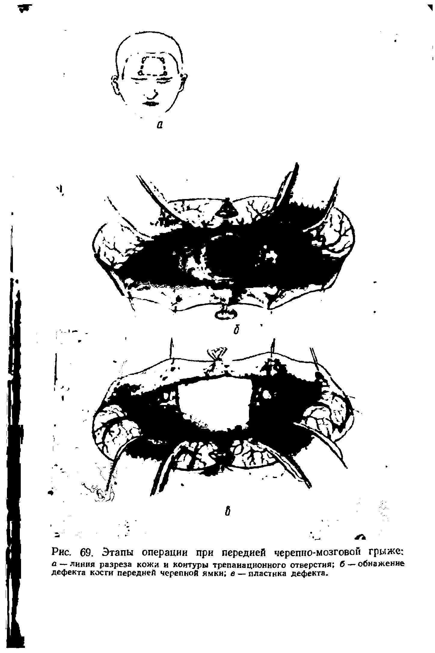 Рис. 69. Этапы операции при передней черепно-мозговой грыже л — линия разреза кожи и контуры трепанационного отверстия б — обнажение дефекта косги передней черепной ямки в — пластика дефекта.