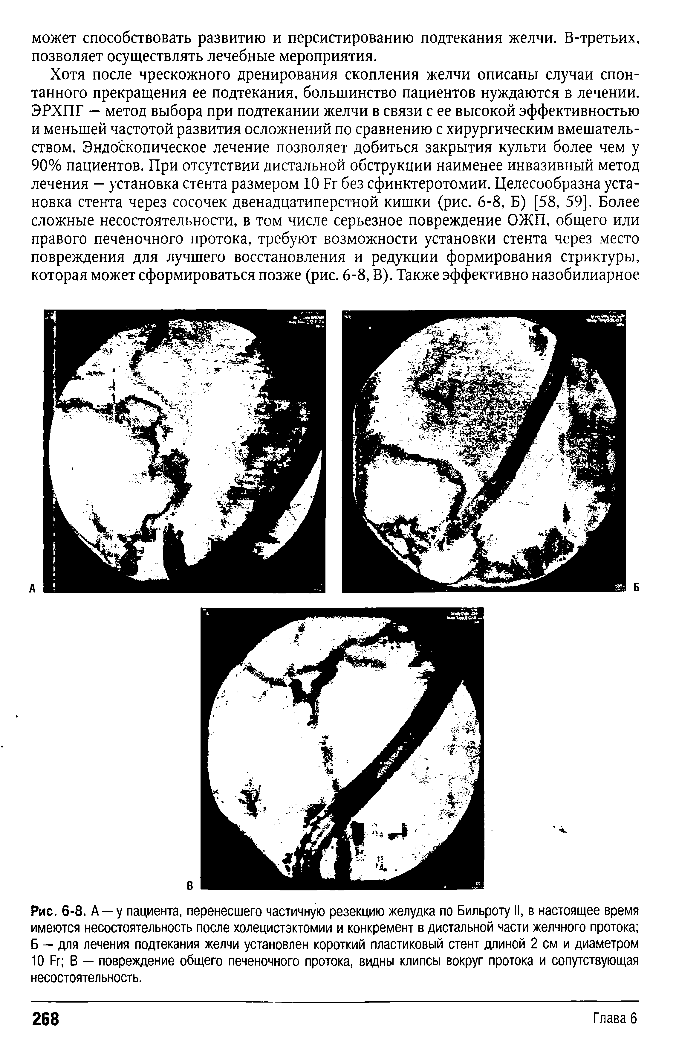 Рис. 6-8. А —у пациента, перенесшего частичную резекцию желудка по Бильроту II, в настоящее время имеются несостоятельность после холецистэктомии и конкремент в дистальной части желчного протока Б — для лечения подтекания желчи установлен короткий пластиковый стент длиной 2 см и диаметром 10 Бг В — повреждение общего печеночного протока, видны клипсы вокруг протока и сопутствующая несостоятельность.