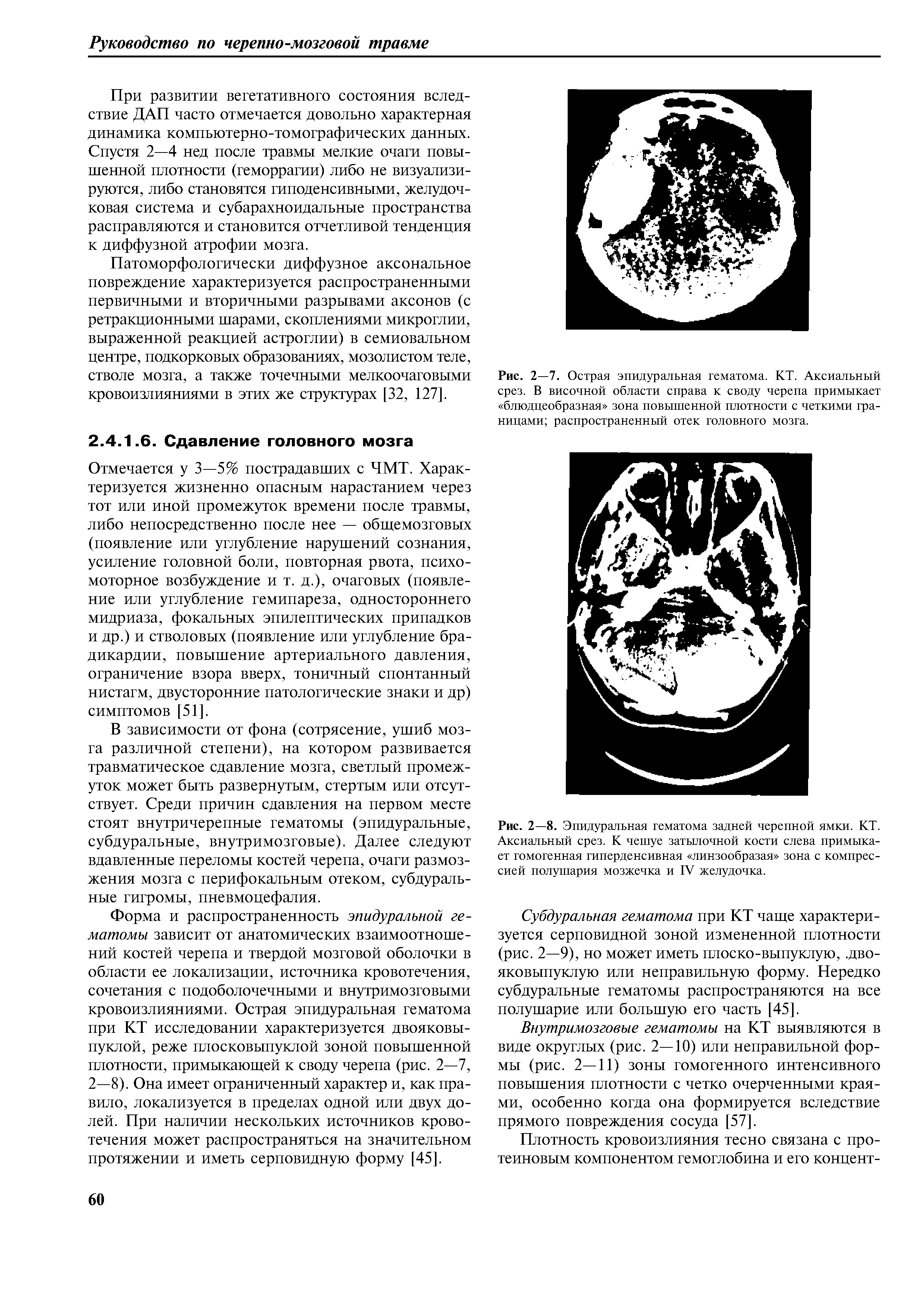 Рис. 2—8. Эпидуральная гематома задней черепной ямки. КТ. Аксиальный срез. К чешуе затылочной кости слева примыкает гомогенная гиперденсивная линзообразая зона с компрессией полушария мозжечка и ГУ желудочка.