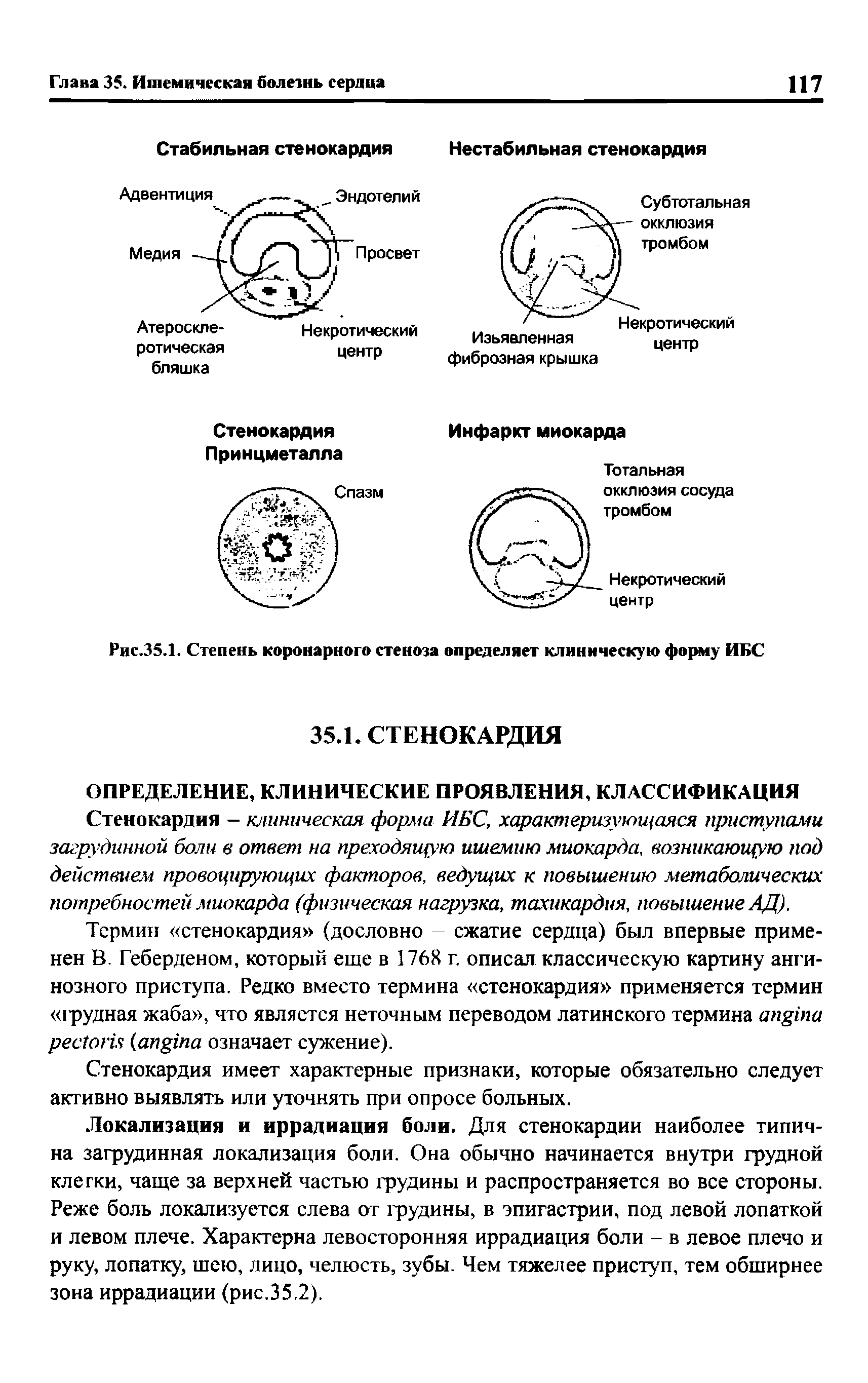 Рис.35.1. Степень коронарного стеноза определяет клиническую форму ИБС...