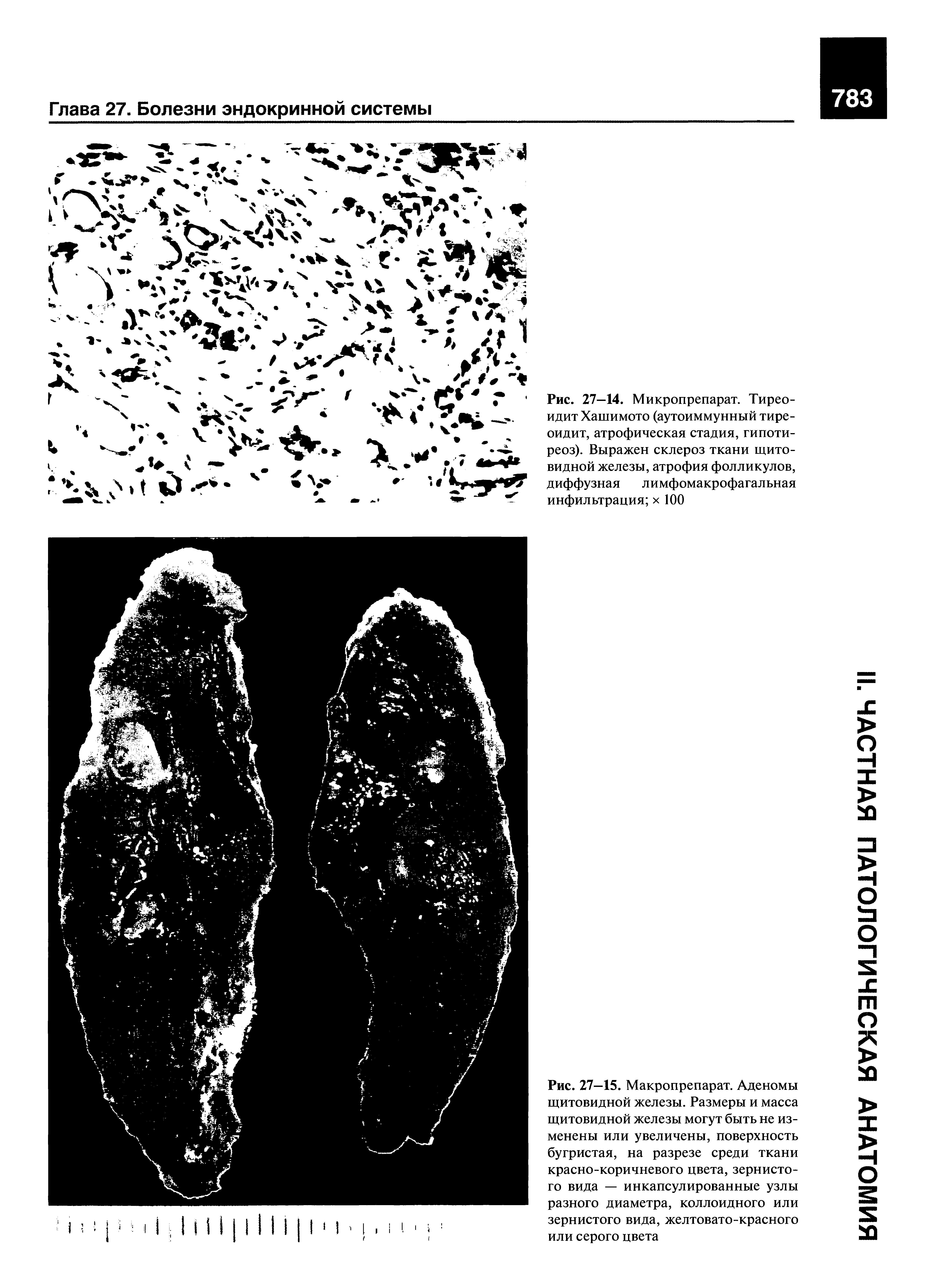 Рис. 27—14. Микропрепарат. Тиреоидит Хашимото (аутоиммунный тиреоидит, атрофическая стадия, гипотиреоз). Выражен склероз ткани щитовидной железы, атрофия фолликулов, диффузная лимфомакрофагальная инфильтрация х 100...