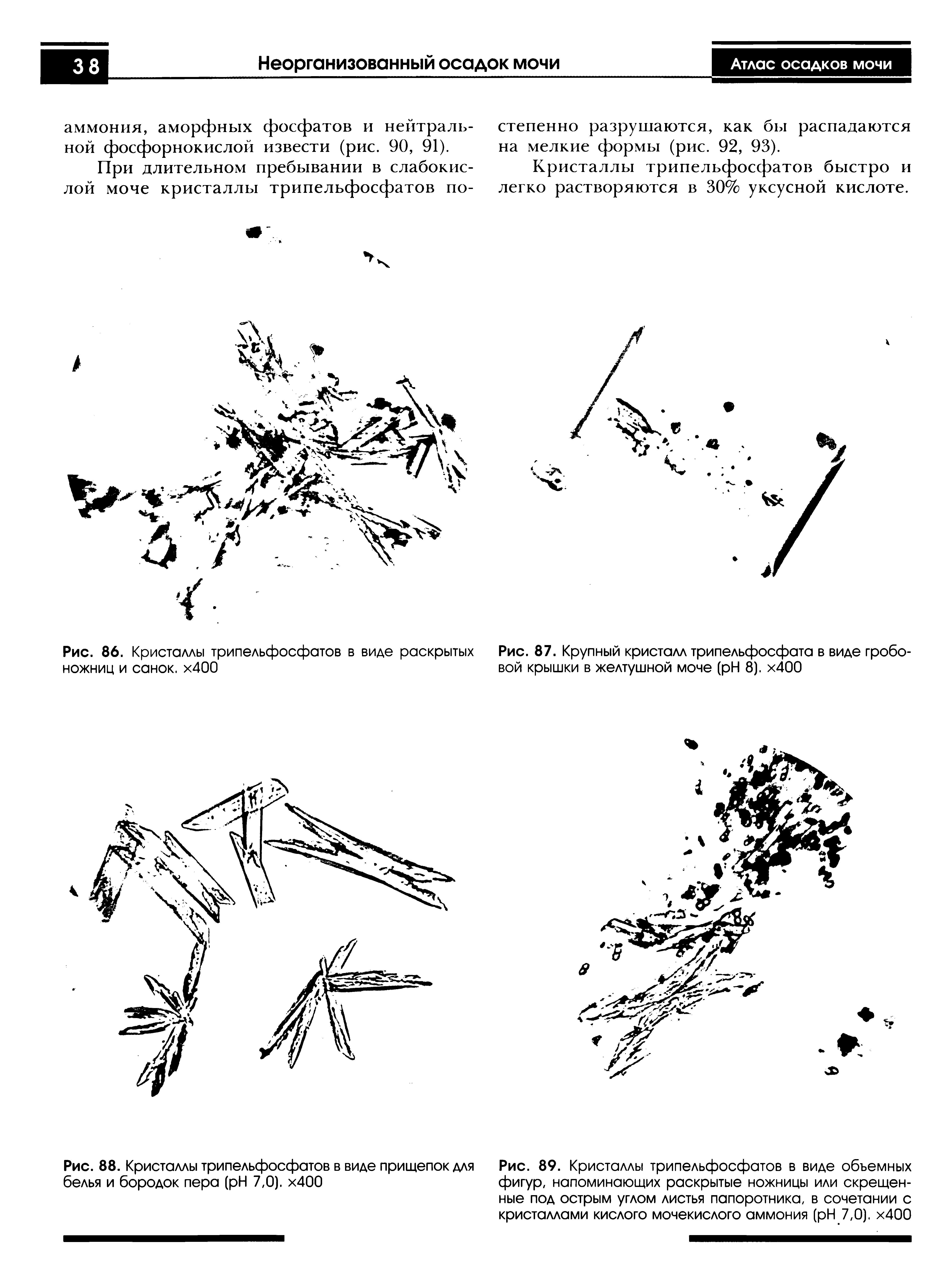 Рис. 89. Кристаллы трипельфосфатов в виде объемных фигур, напоминающих раскрытые ножницы или скрещенные под острым углом листья папоротника, в сочетании с кристаллами кислого мочекислого аммония ( H 7,0). х400...