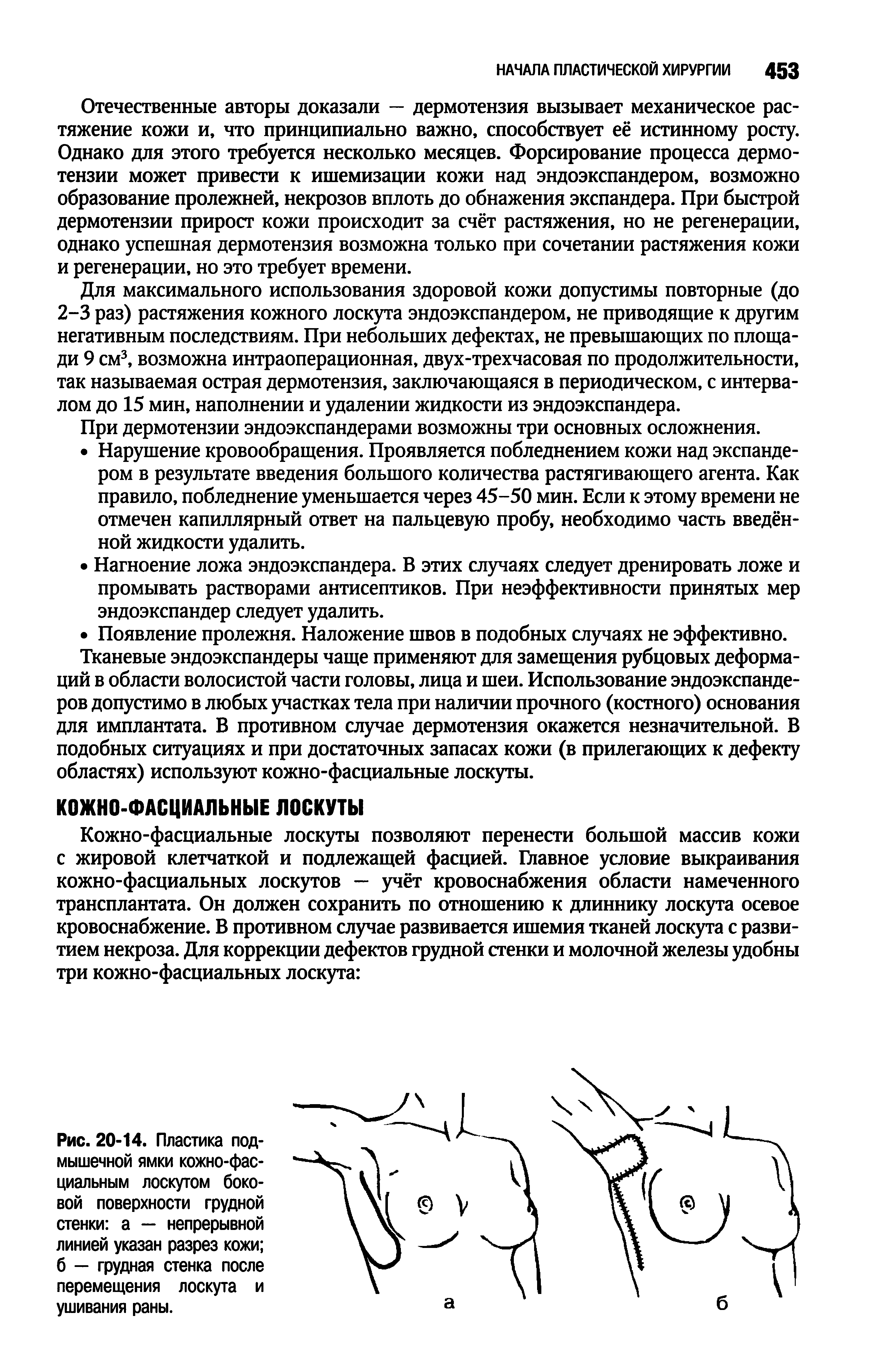 Рис. 20-14. Пластика подмышечной ямки кожно-фасциальным лоскутом боковой поверхности грудной стенки а — непрерывной линией указан разрез кожи б — грудная стенка после перемещения лоскута и ушивания раны.