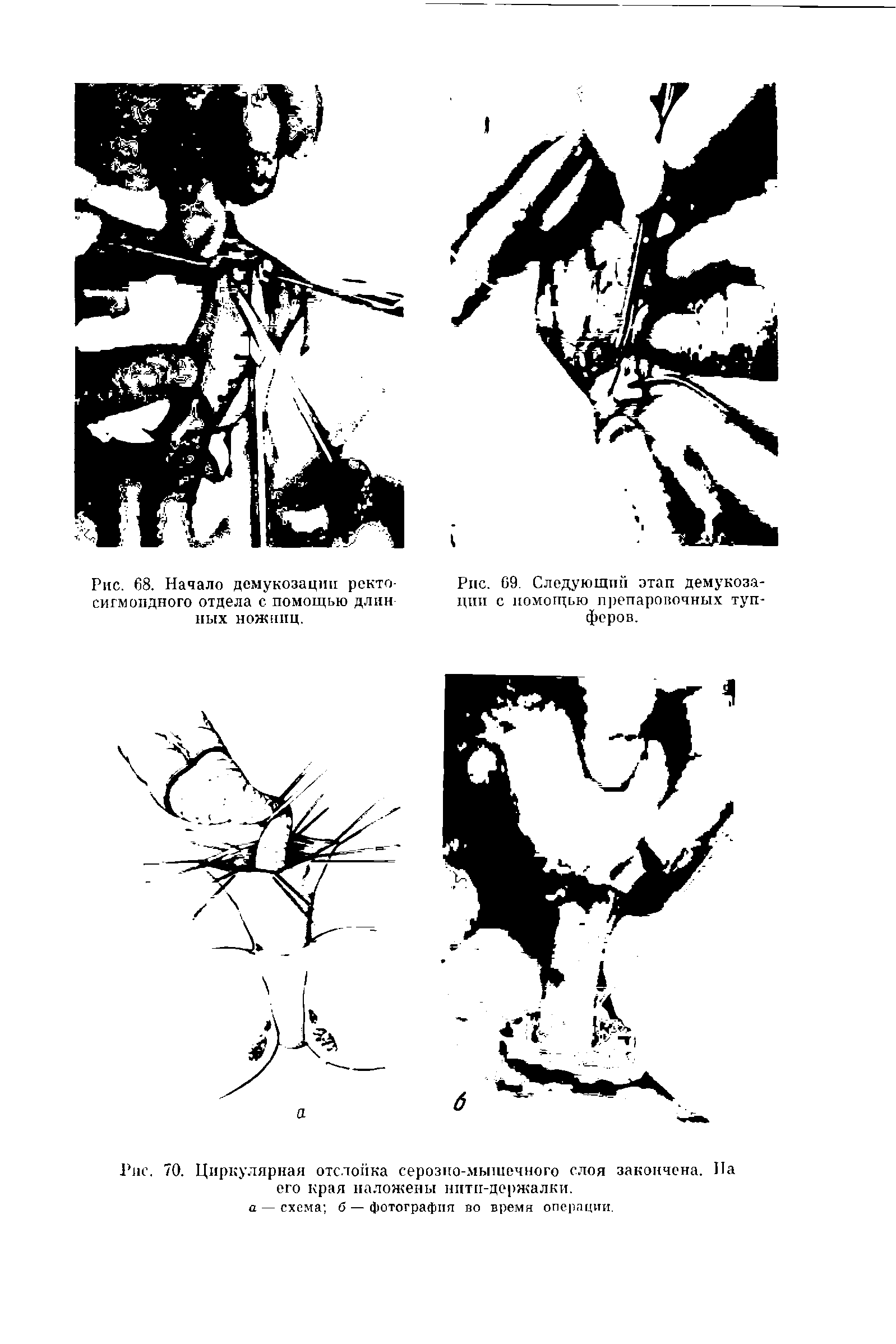 Рис. 70. Циркулярная отслойка серозно-мышечного слоя закопчена. Па его края наложены нити-держалки.