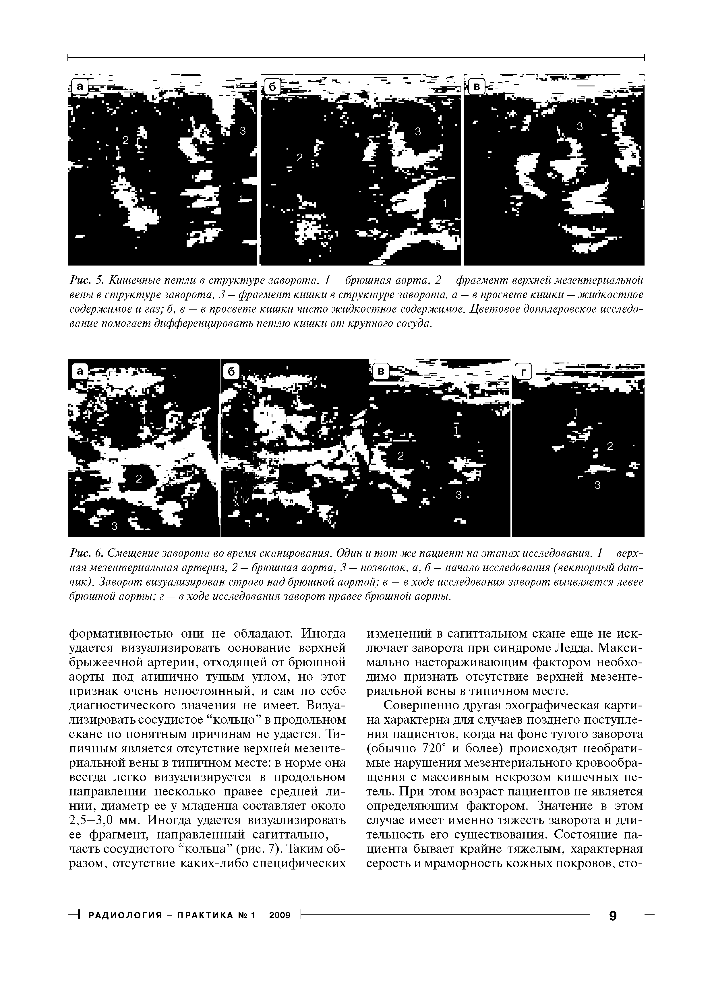 Рис. 6. Смещение заворота во время сканирования. Один и тот же пациент на этапах исследования. 1 — верхняя мезентериальная артерия, 2 — брюшная аорта, 3 — позвонок, а, б — начало исследования (векторный датчик). Заворот визуализирован строго над брюшной аортой в — в ходе исследования заворот выявляется левее брюшной аорты г — в ходе исследования заворот правее брюшной аорты.