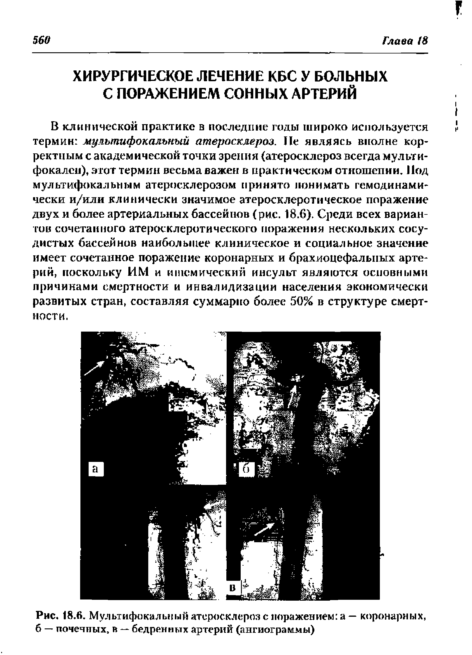 Рис. 18.6, Мультифокальный атеросклероз с поражением а — коронарных, б — почечных, в — бедренных артерий (ангиограммы)...