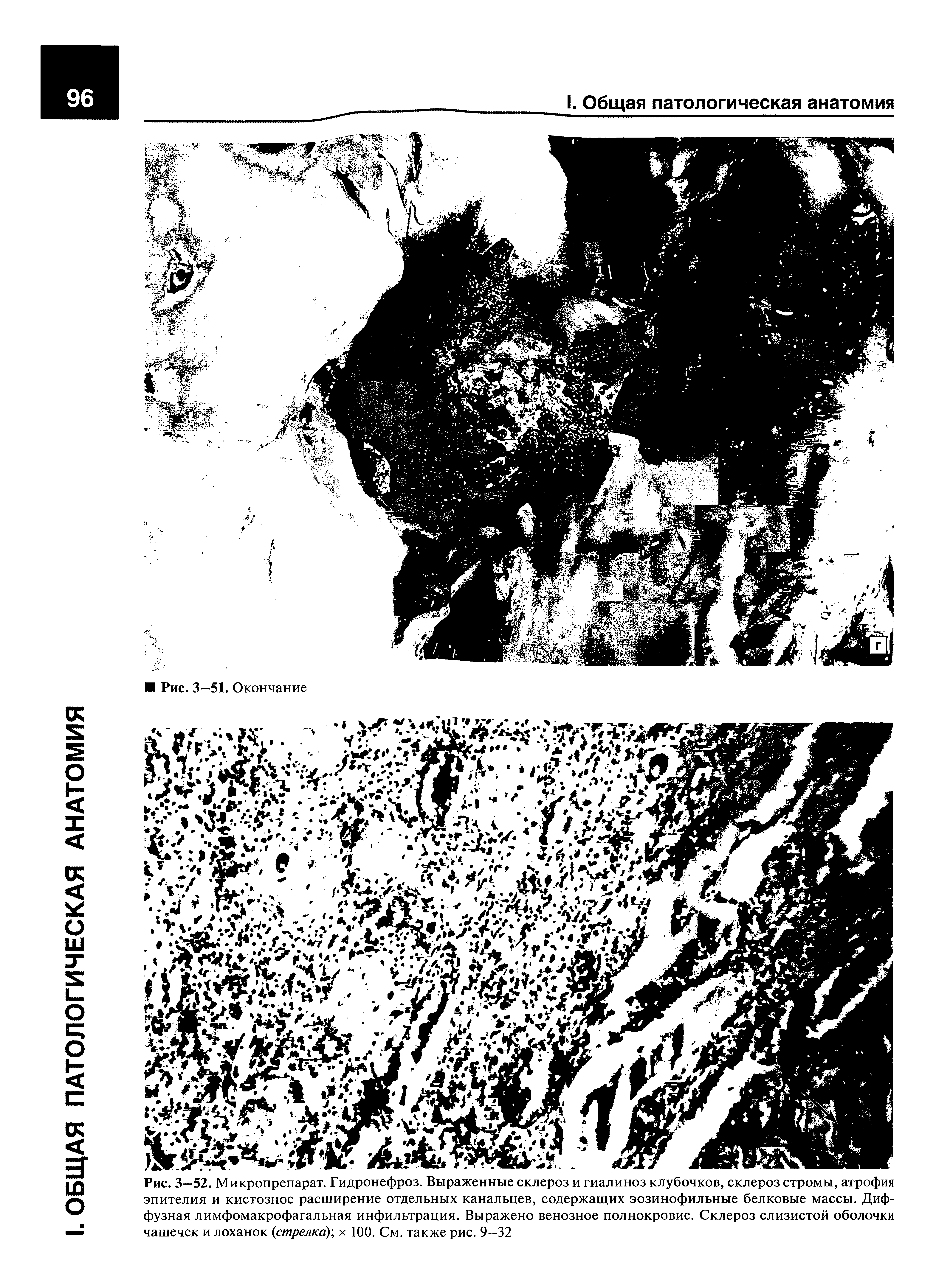 Рис. 3—52. Микропрепарат. Гидронефроз. Выраженные склероз и гиалиноз клубочков, склероз стромы, атрофия эпителия и кистозное расширение отдельных канальцев, содержащих эозинофильные белковые массы. Диффузная лимфомакрофагальная инфильтрация. Выражено венозное полнокровие. Склероз слизистой оболочки чашечек и лоханок (стрелка), х 100. См. также рис. 9—32...