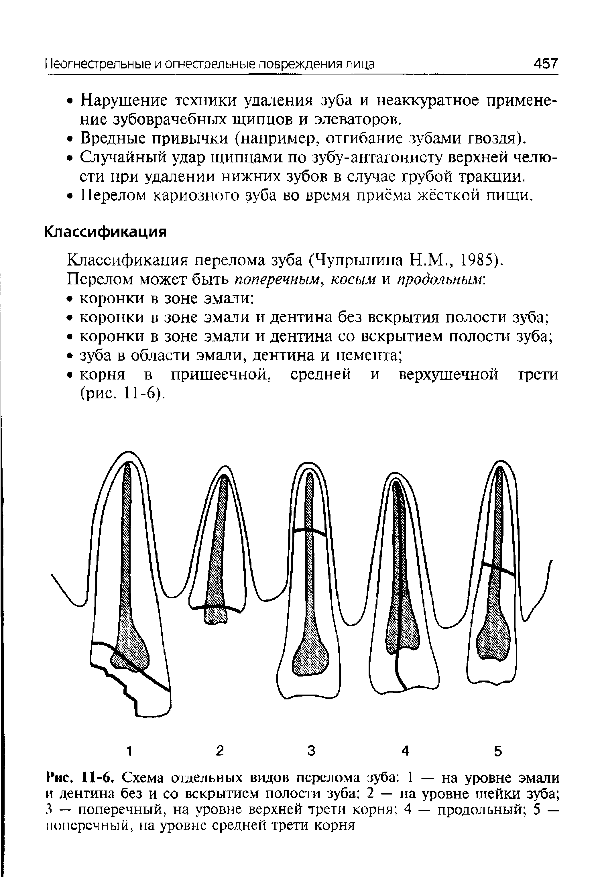 Рис. 11-6. Схема отдельных видов перелома зуба 1 — на уровне эмали и дентина без и со вскрытием полости зуба 2 — на уровне шейки зуба 3 — поперечный, на уровне верхней трети корня 4 — продольный 5 — поперечный, на уровне средней трети корня...