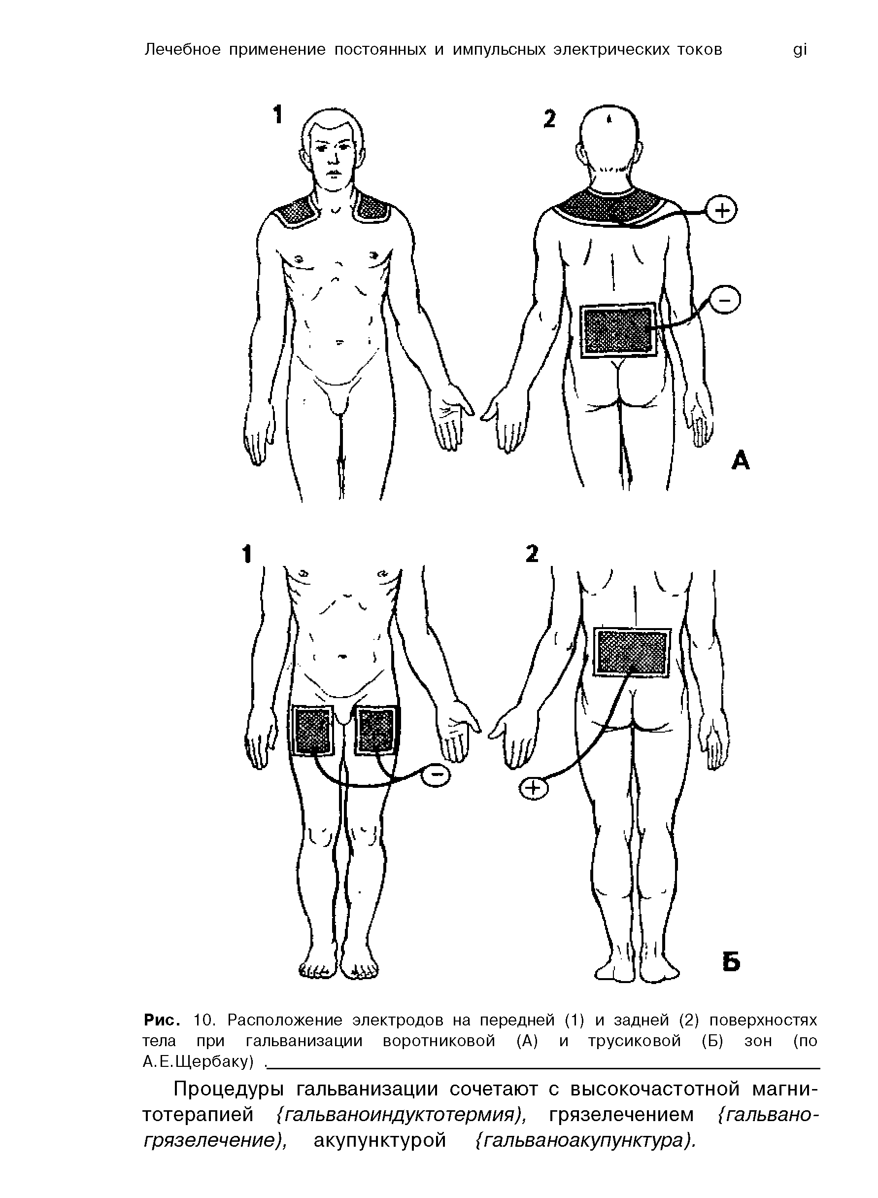 Рис. 10. Расположение электродов на передней (1) и задней (2) поверхностях тела при гальванизации воротниковой (А) и трусиковой (Б) зон (по А. Е. Щербаку). ...
