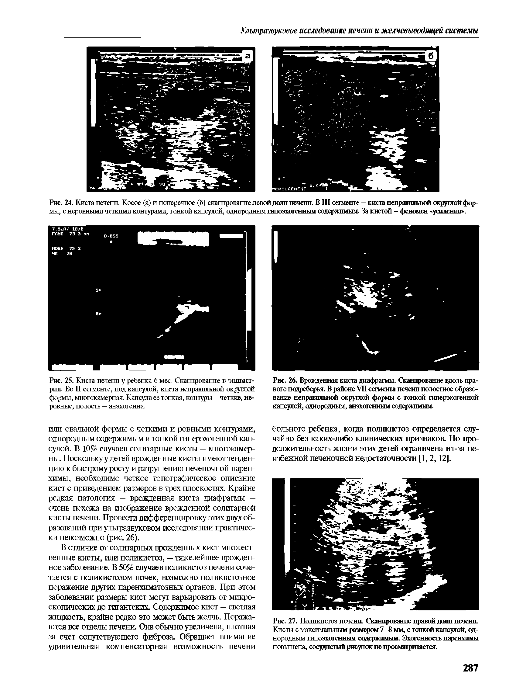 Рис. 26. Врожденная киста диафрагмы. Сканирование вдоль правого подреберья. В районе VII сегмента печенп полостное образование неправильной округлой формы с тонкой гиперэхогенной капсулой, однородным, анэхогенным содержимым.