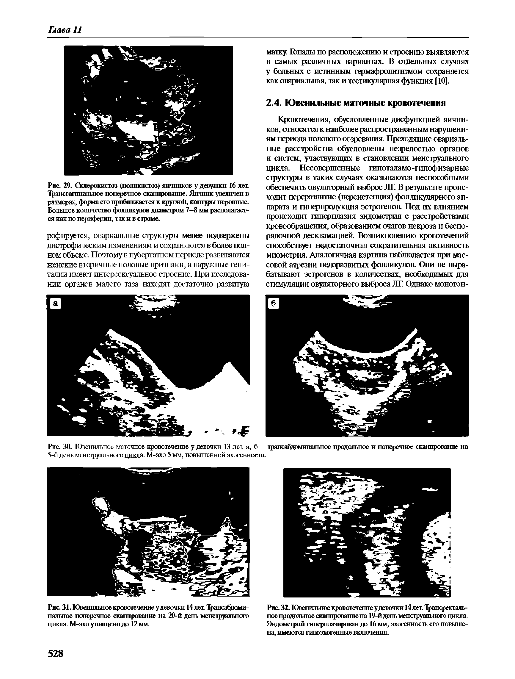 Рис. 30. Ювенильное маточное кровотечение у девочки 13 лет. а, б трансабдоминальное продольное и поперечное сканпрованпе на 5-й день менструального цикла. М-эхо 5 мм, повышенной эхогенностп.