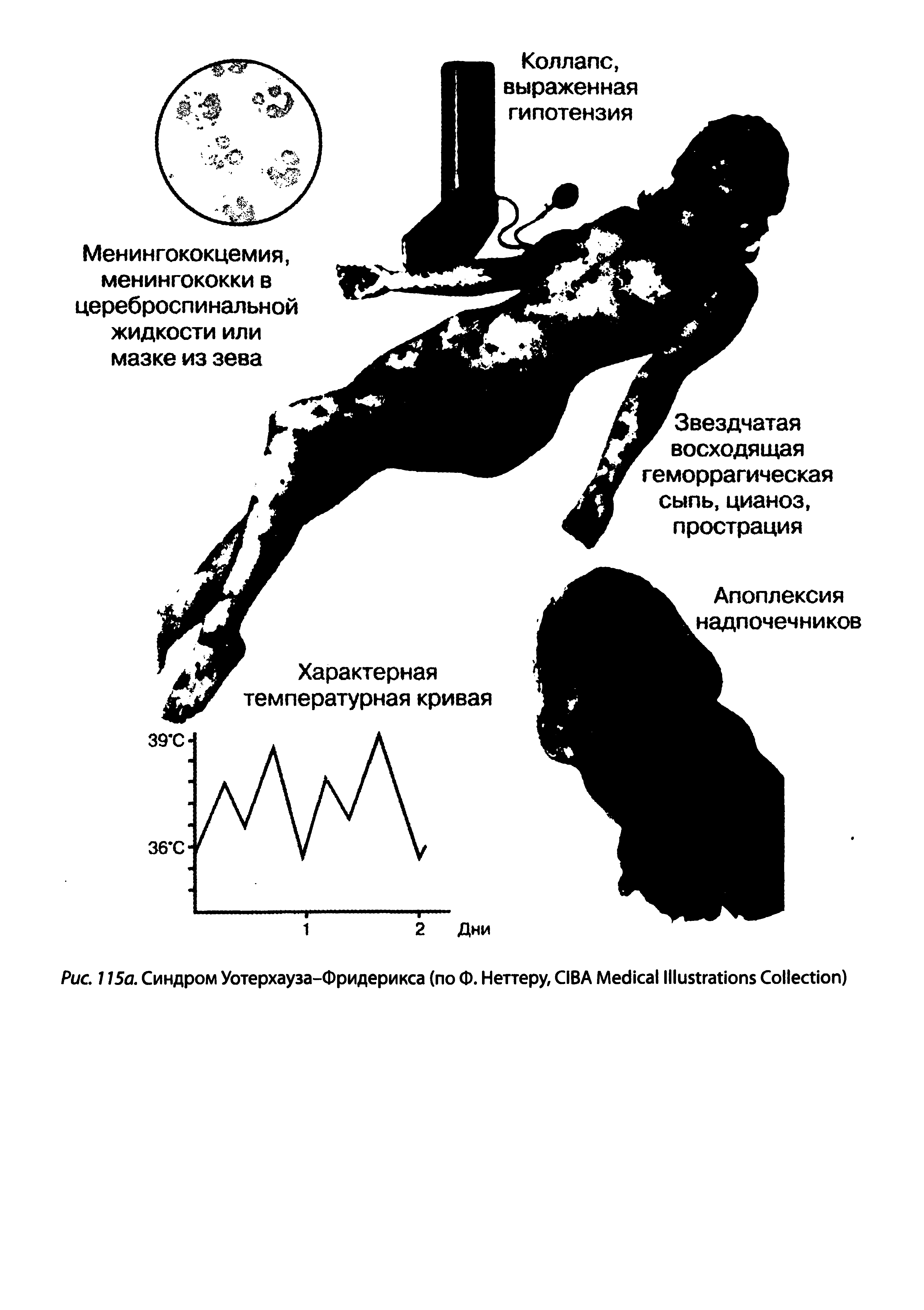 Рис. 115а. Синдром Уотерхауза-Фридерикса (по Ф. Неттеру, CIBA M I C )...