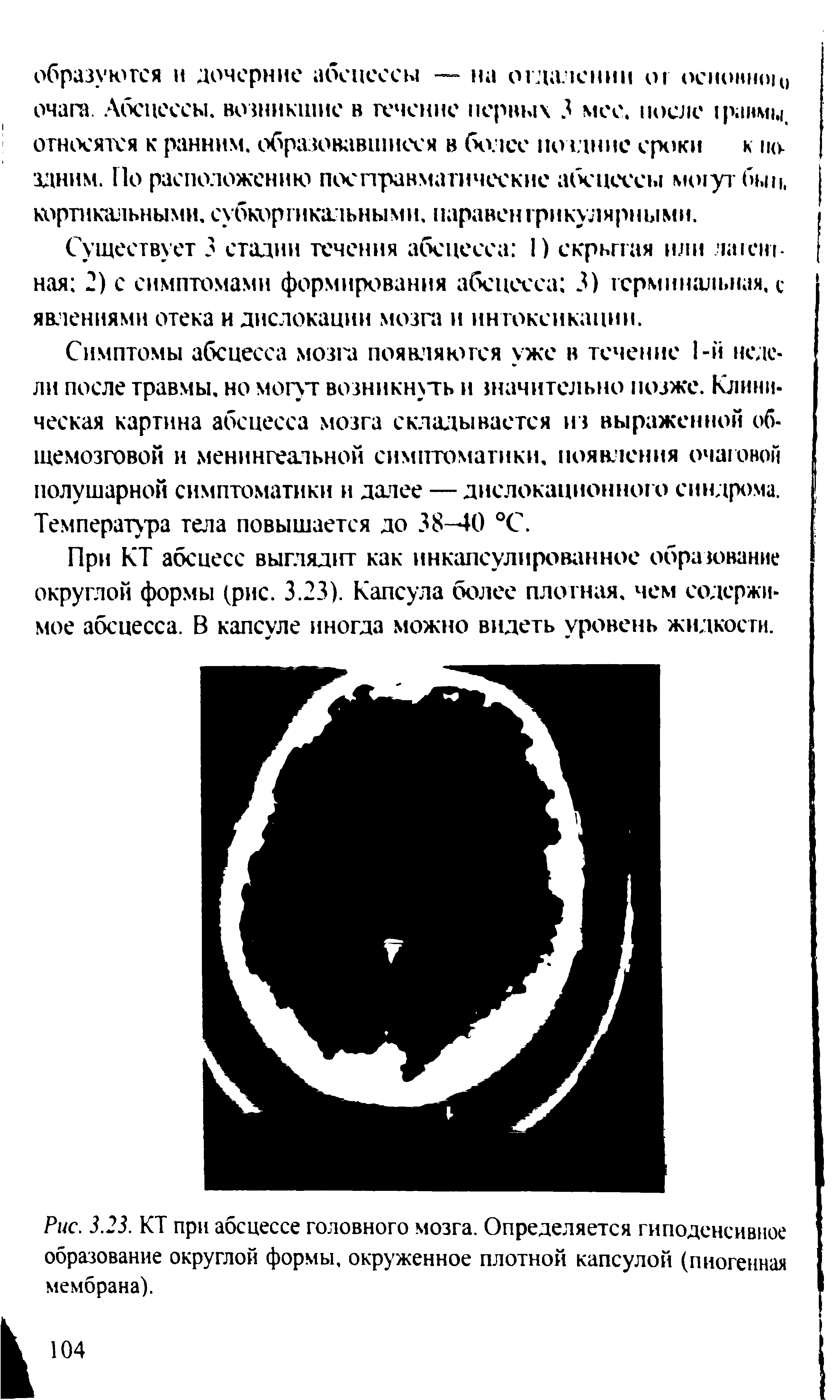 Рис. 3.23. КТ при абсцессе головного мозга. Определяется гиподенсивиое образование округлой формы, окруженное плотной капсулой (пиогенная мембрана).