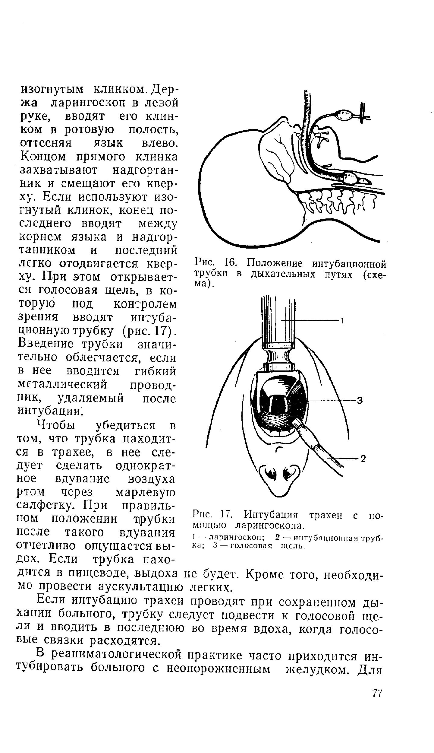 Рис. 16. Положение интубационной трубки в дыхательных путях (схема).